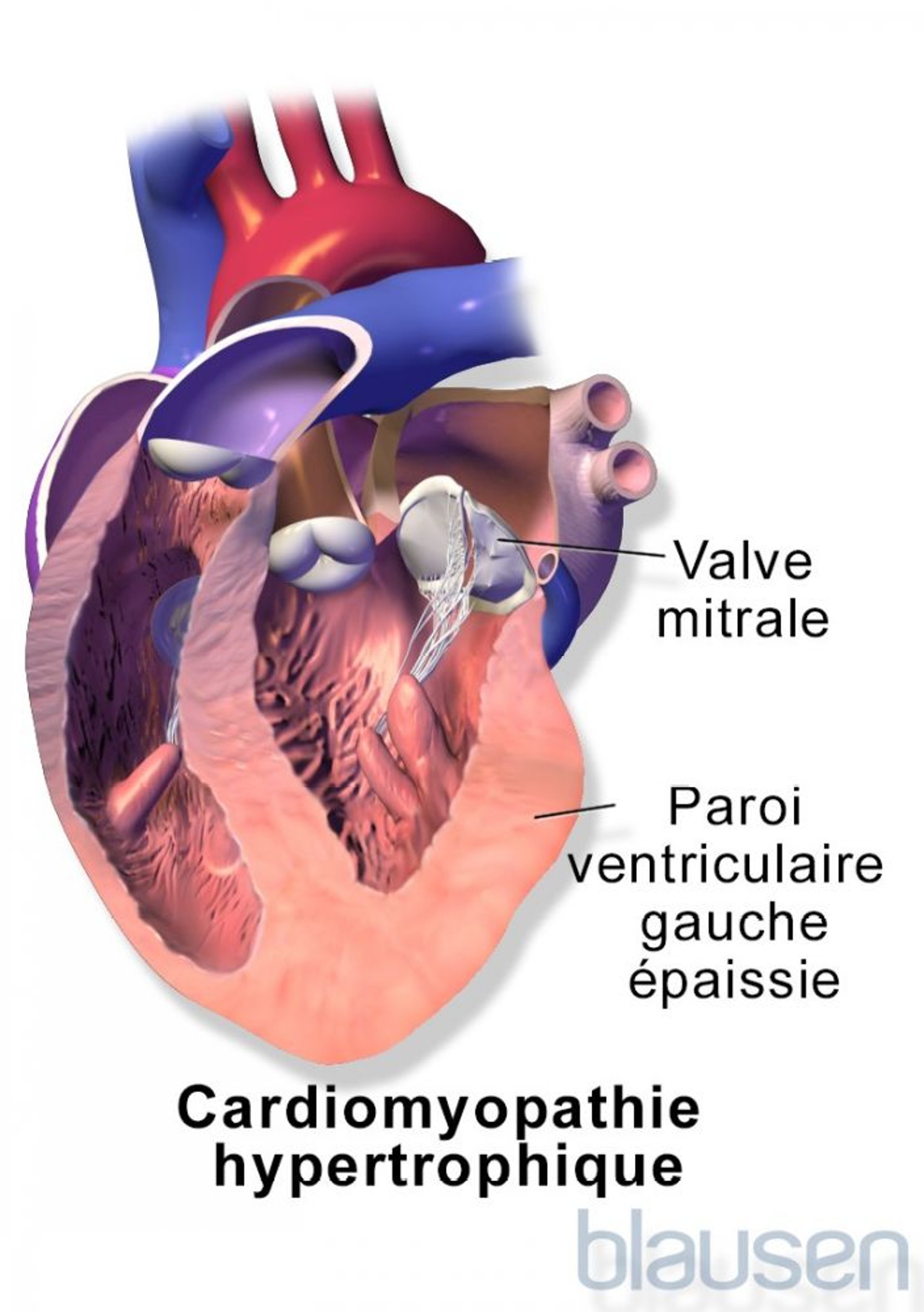 Cardiomyopathie hypertrophique
