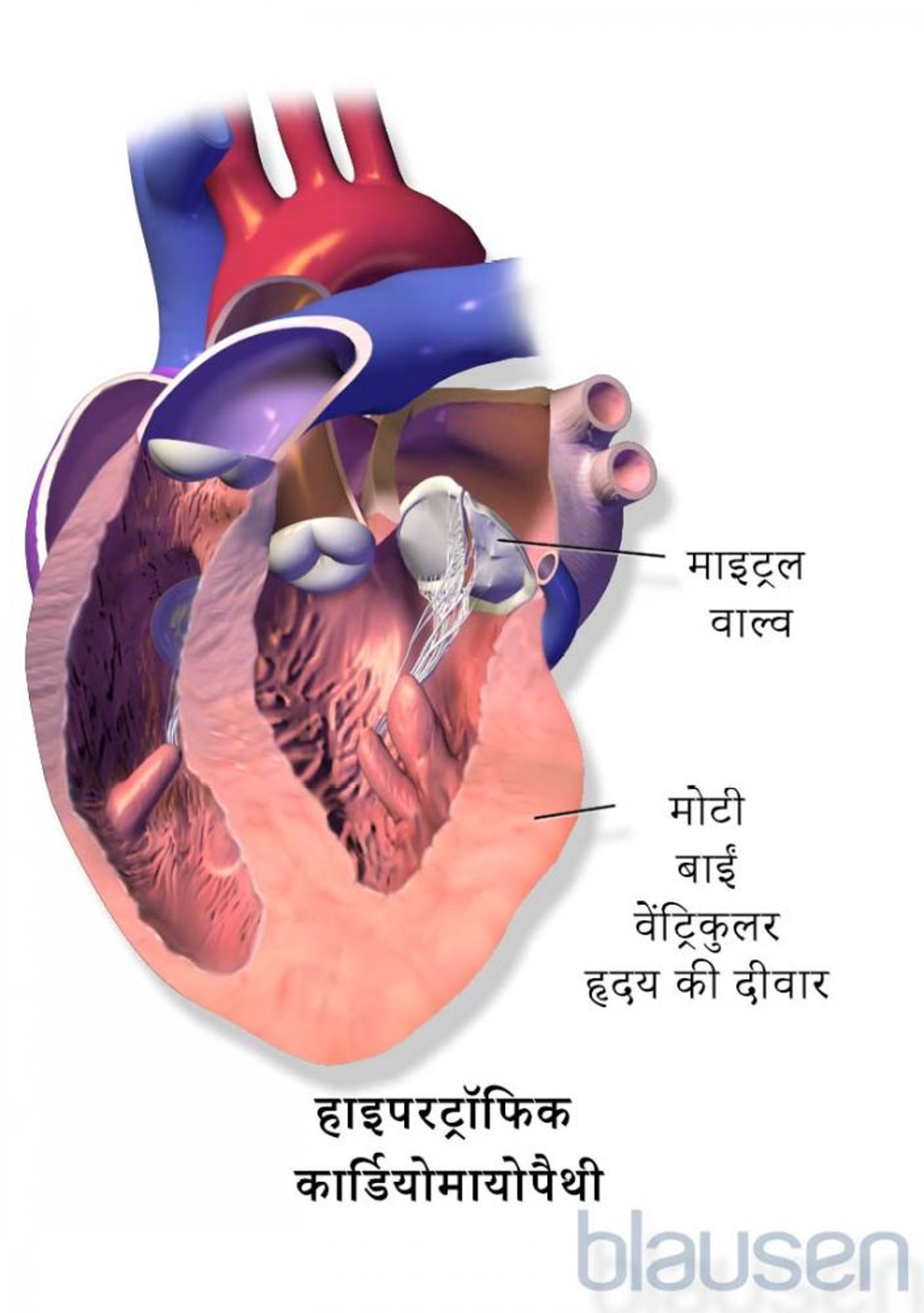 हाइपरट्रॉफिक कार्डियोमायोपैथी