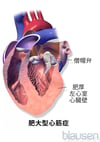 肥大型心筋症