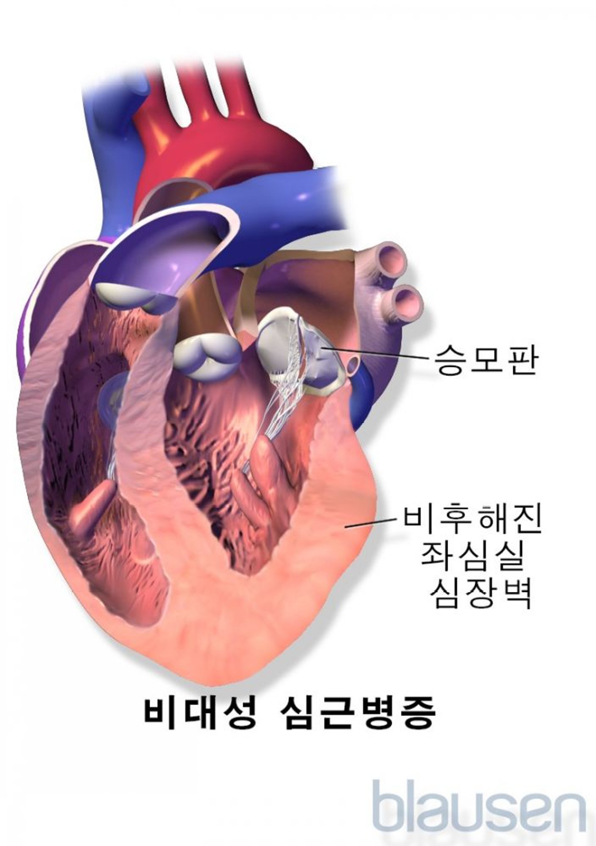비대성 심근병증