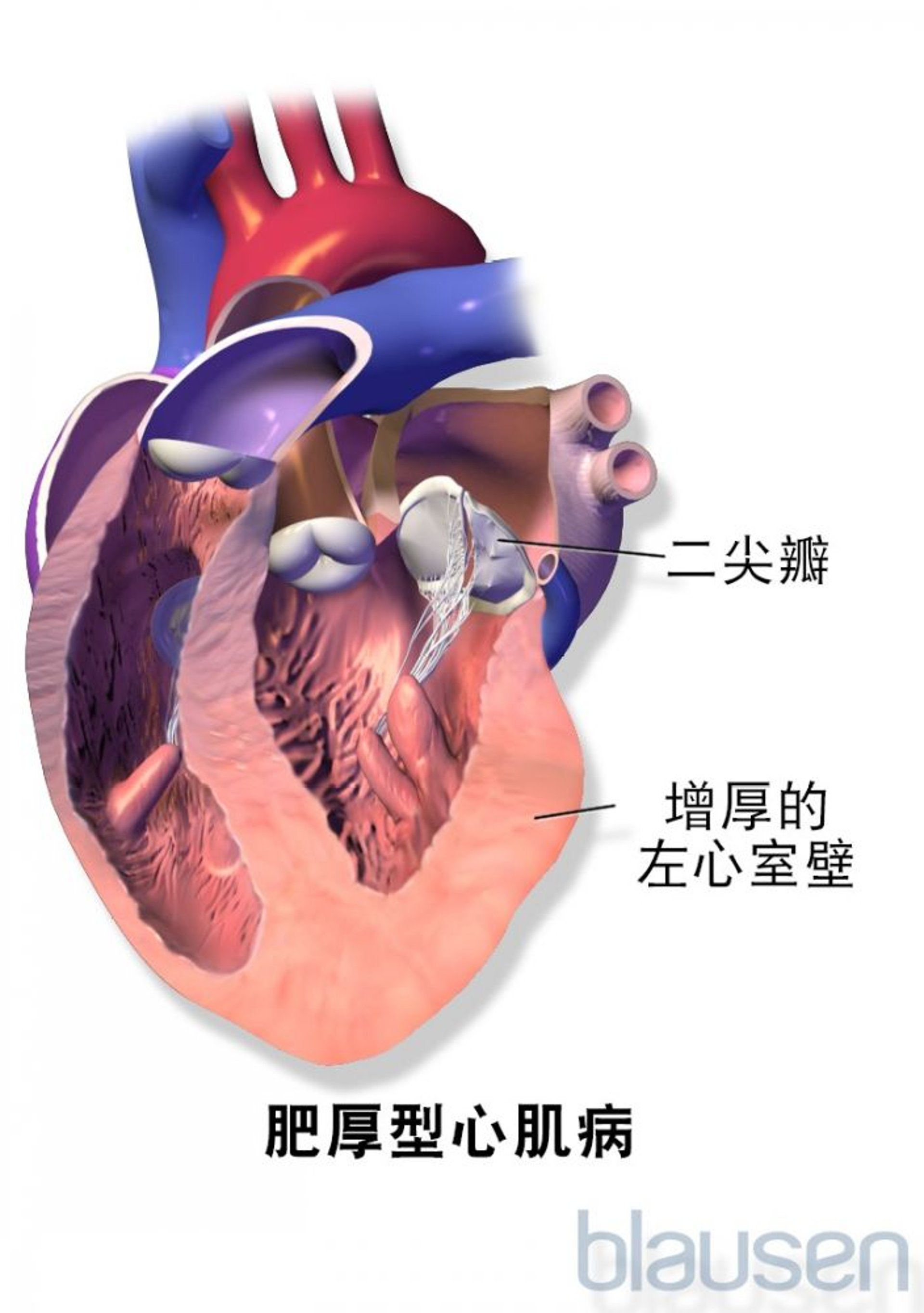 肥厚型心肌病