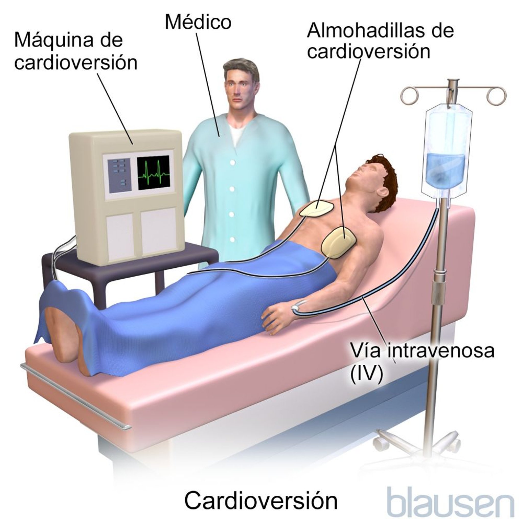 Cardioversion