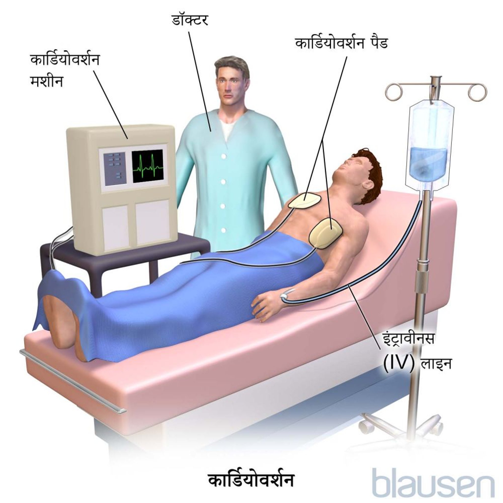 कार्डियोवर्शन