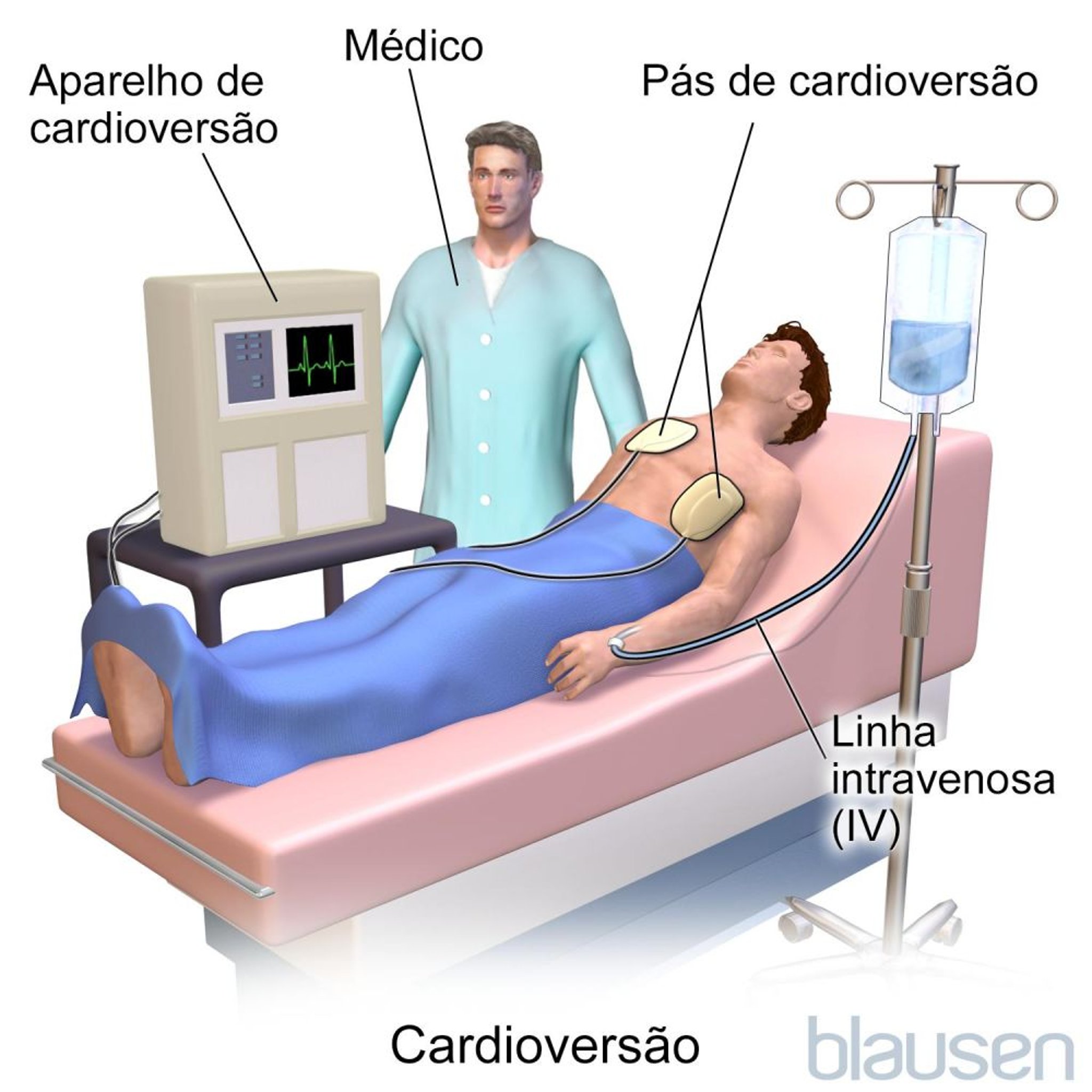 Cardioversão