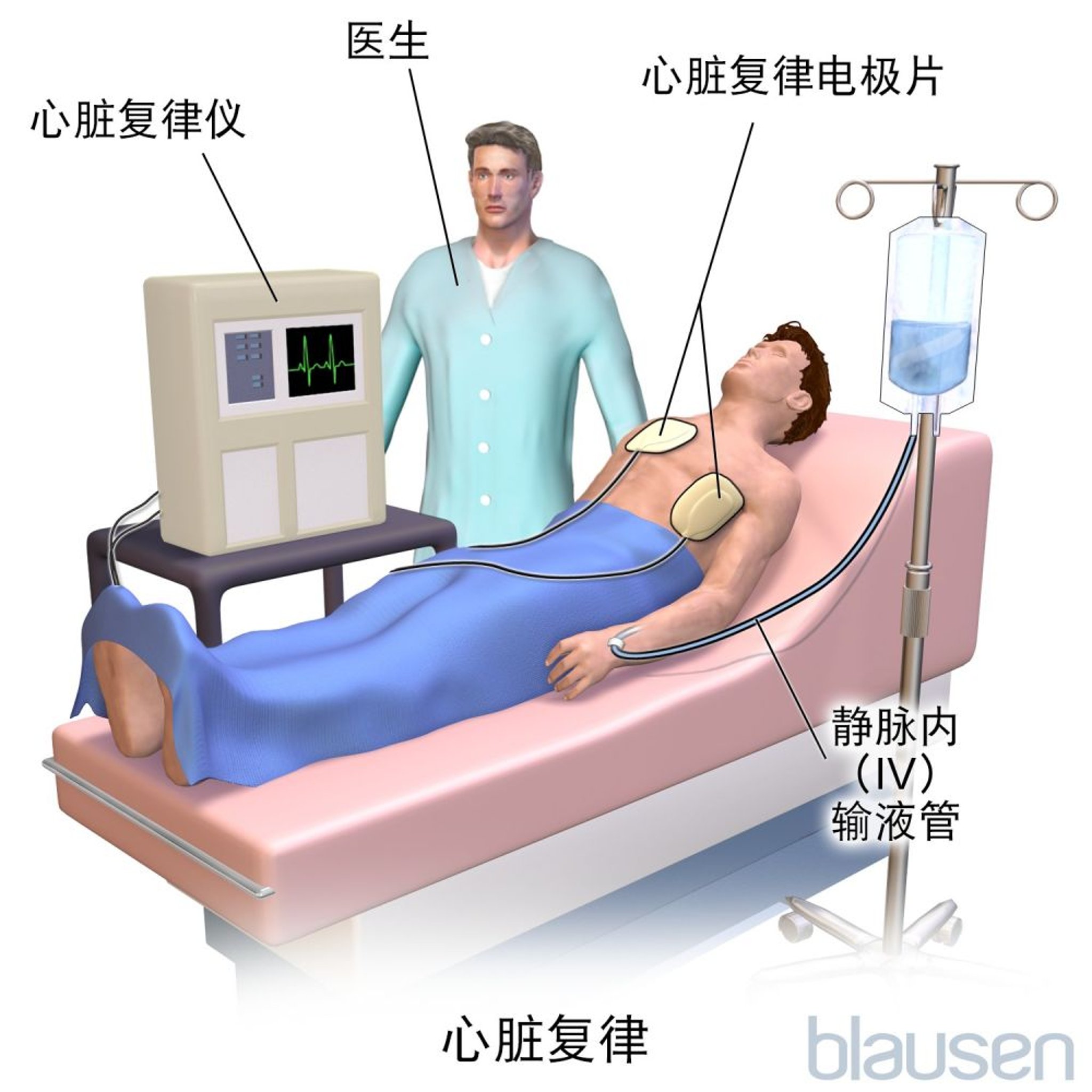 心脏电复律