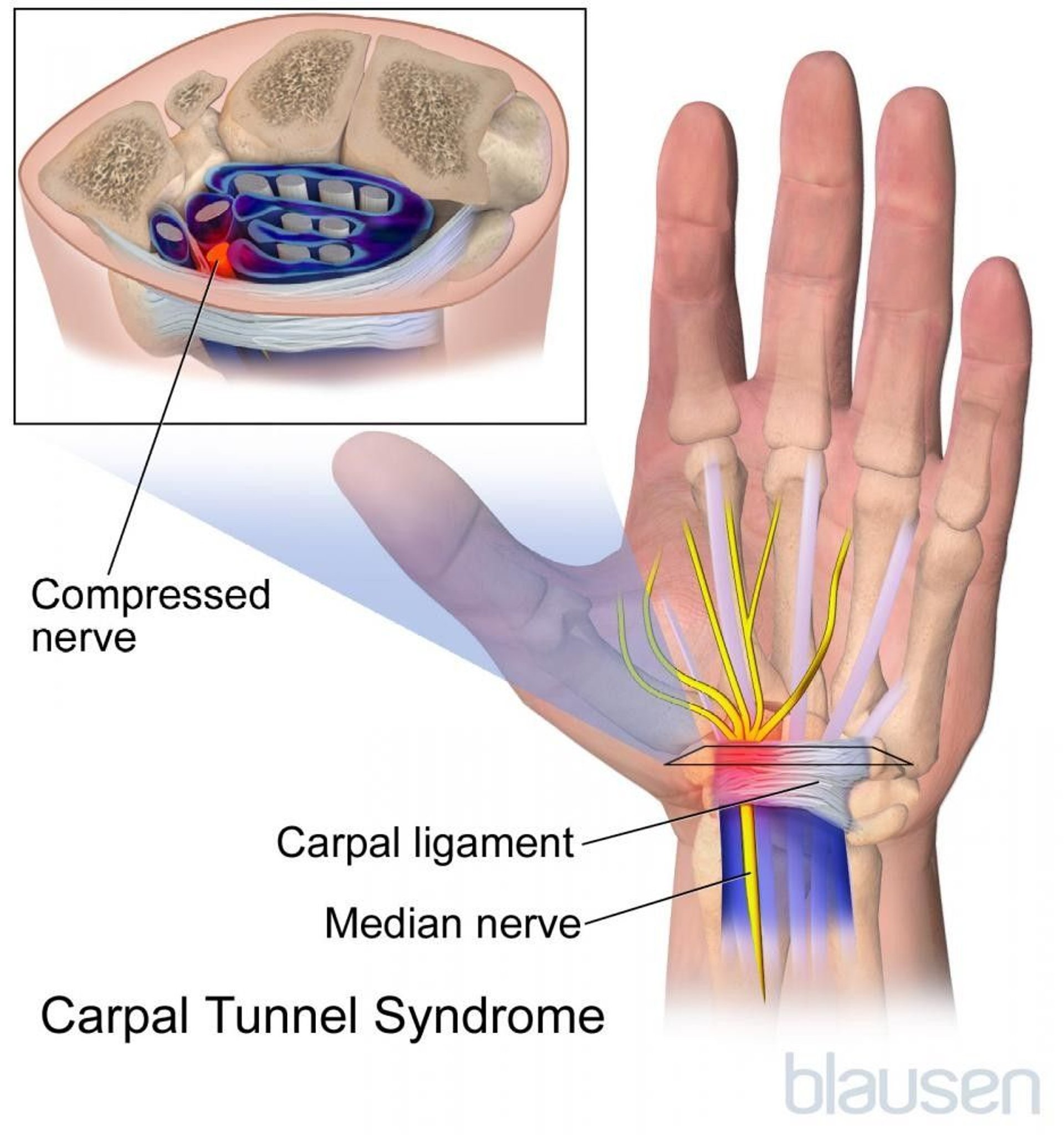 Carpal Tunnel Syndrome