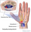 Karpaltunnelsyndrom