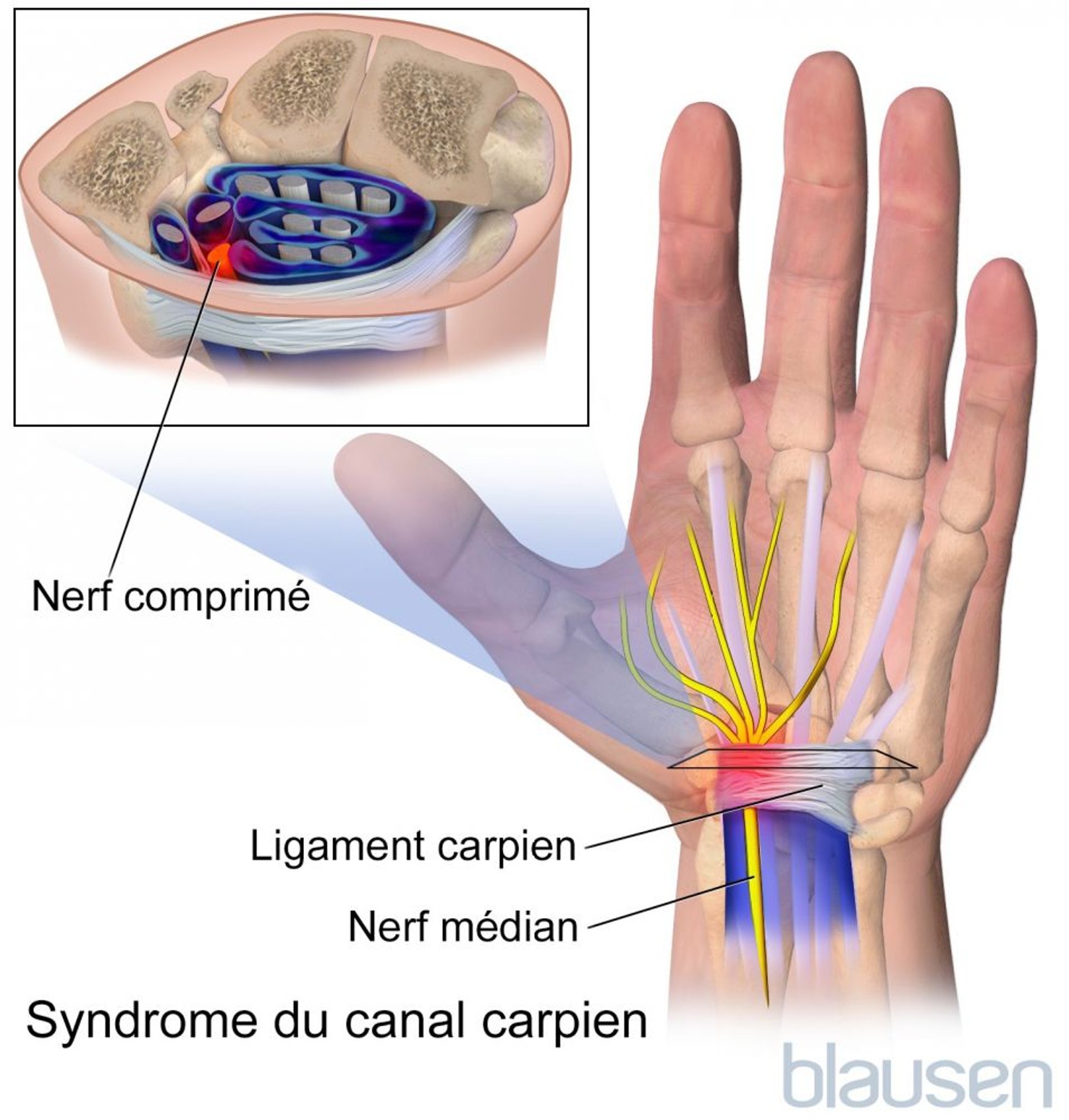 Syndrome du canal carpien