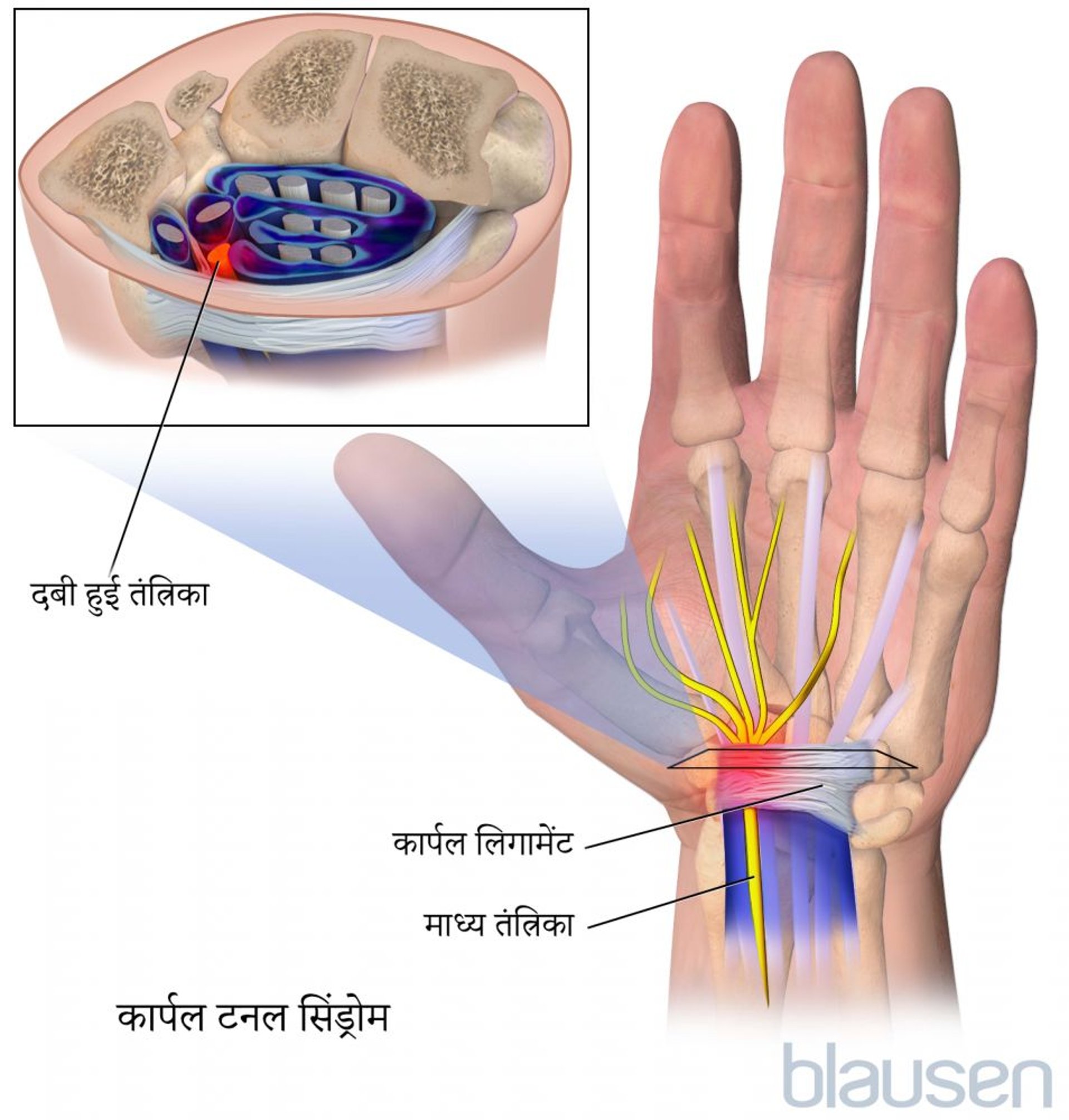 कार्पल टनल सिंड्रोम