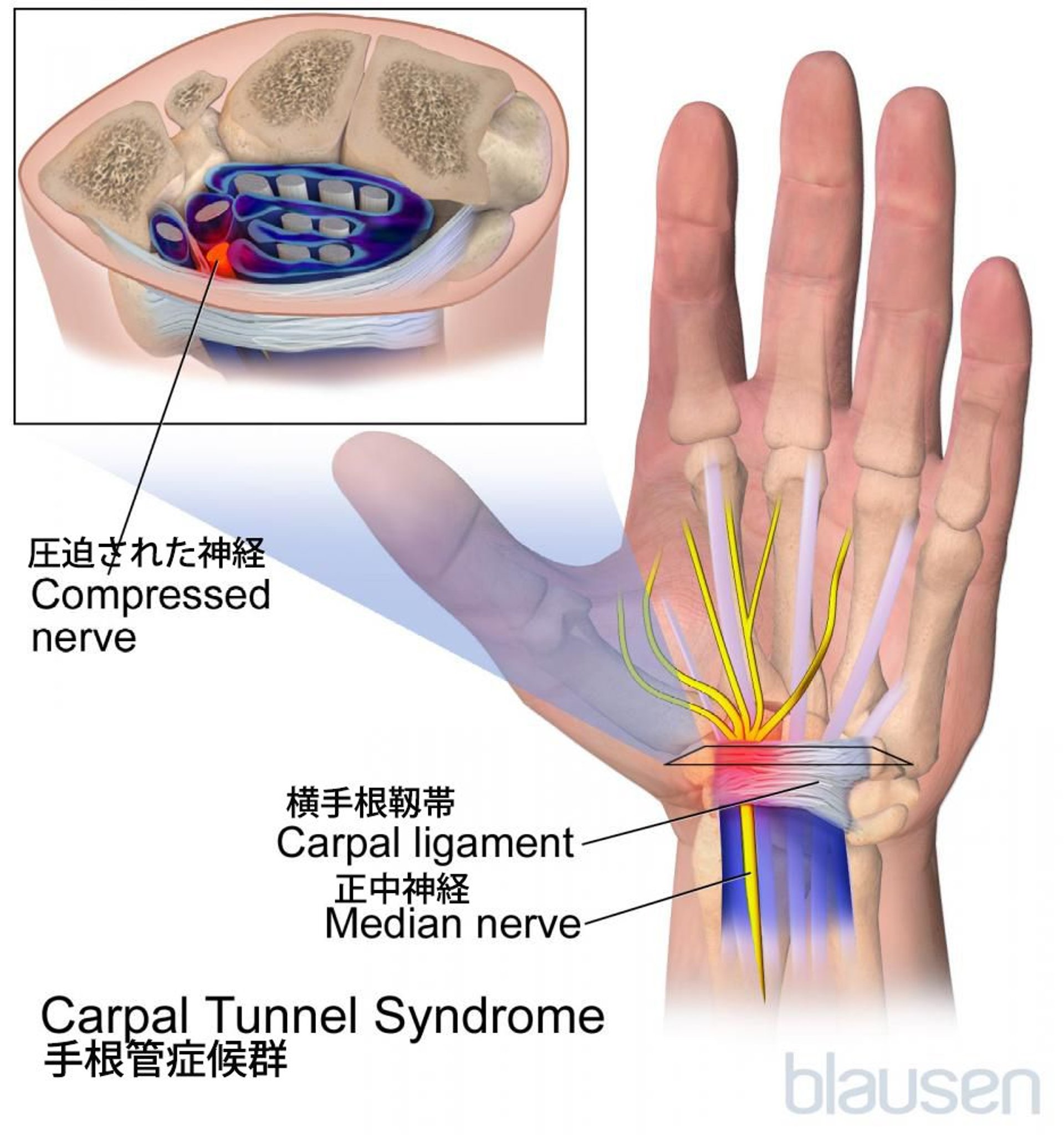 <ruby >手根管症候群<rt >しゅこんかんしょうこうぐん</rt></ruby>