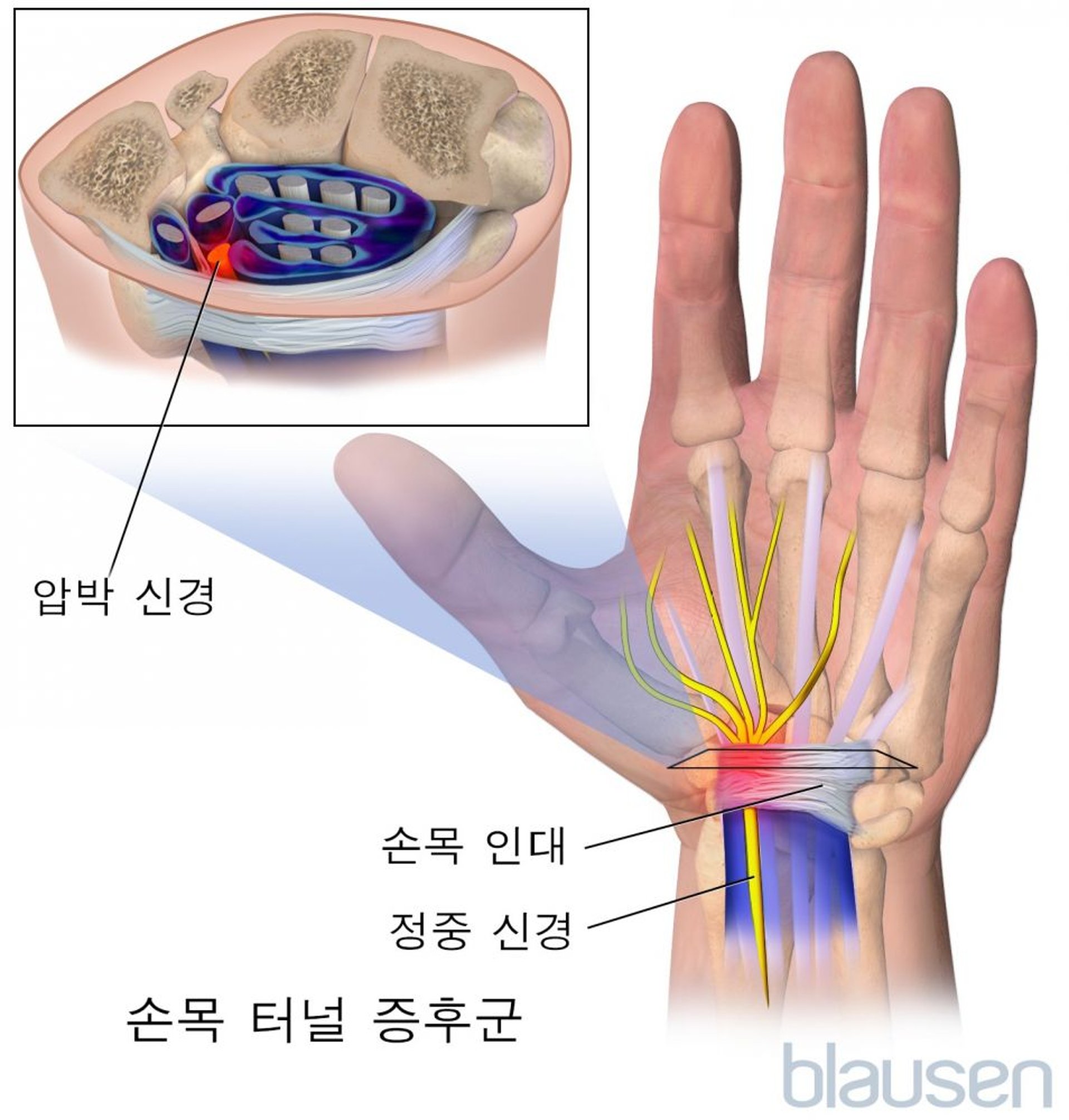 손목 터널 증후군