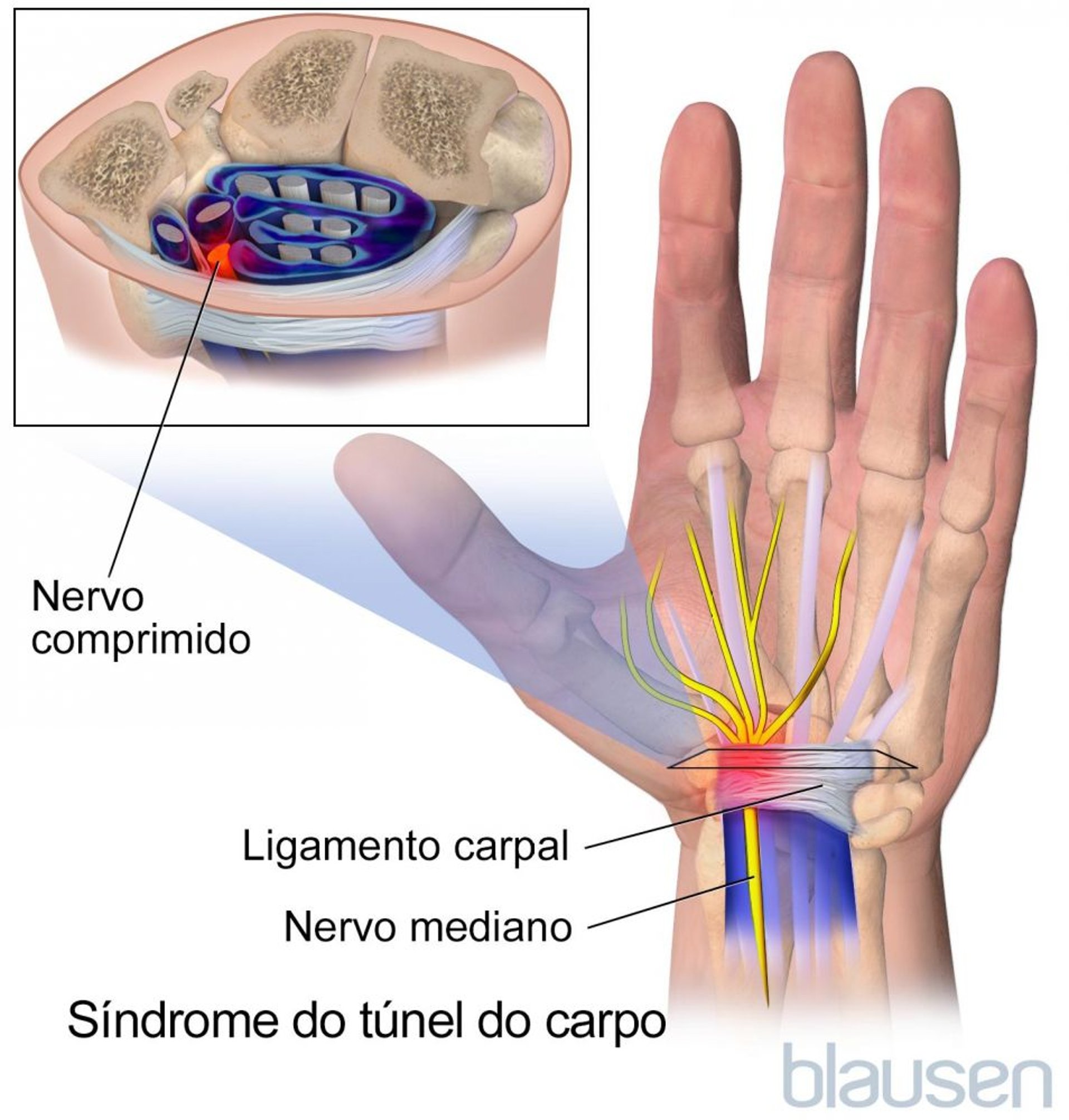 Síndrome do túnel do carpo