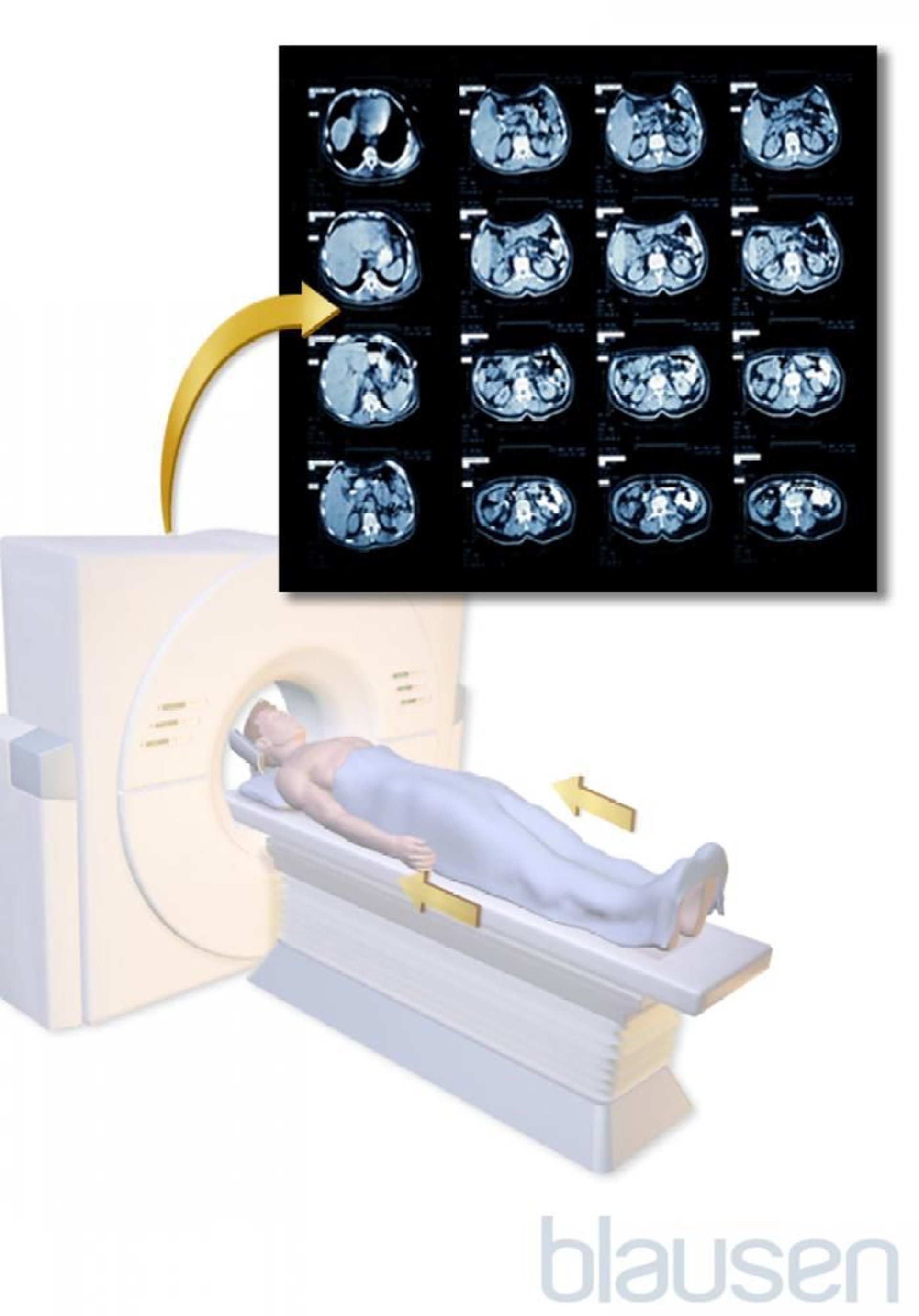 Tomografia computadorizada do abdômen