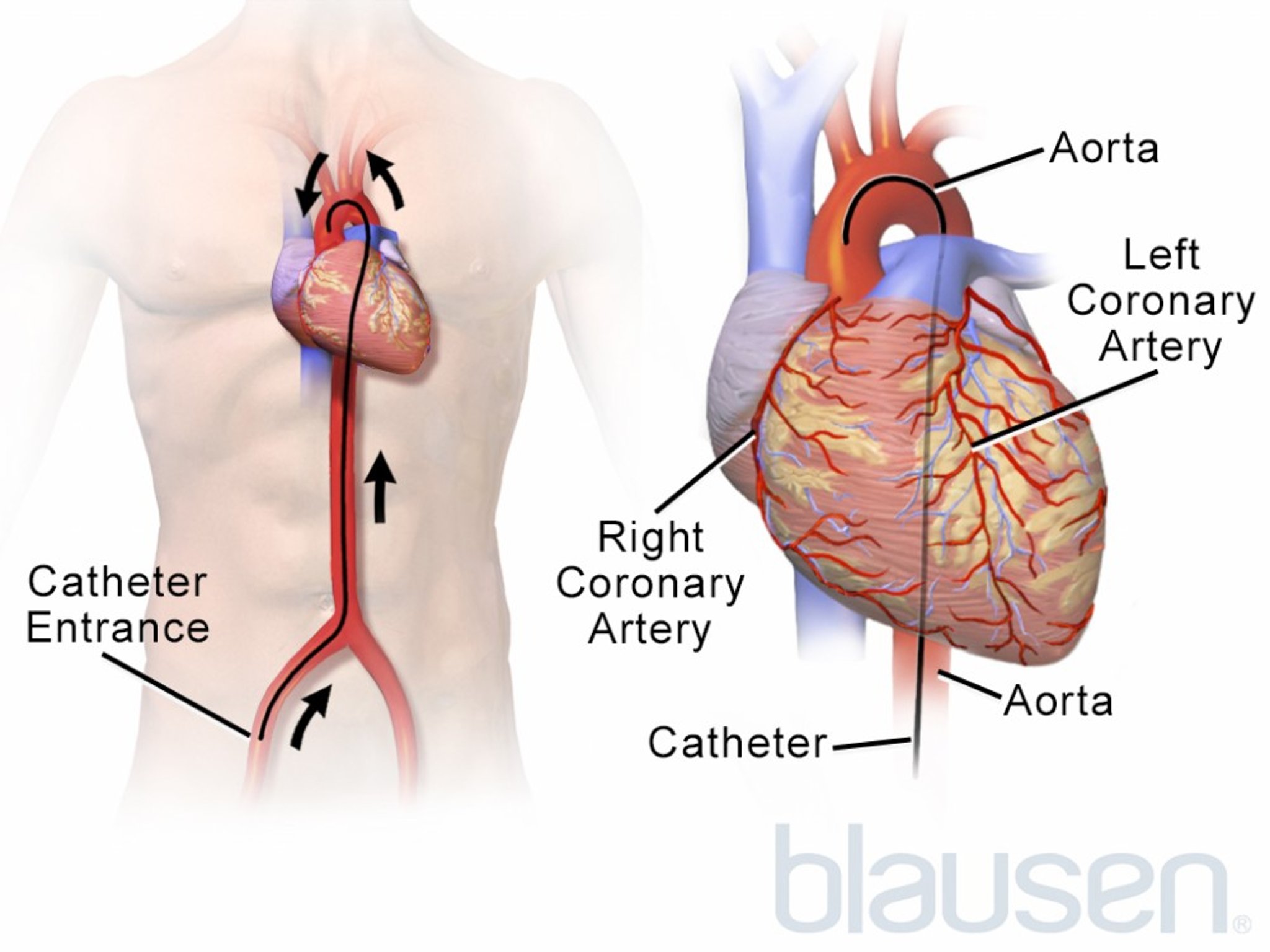 Heart Catheter