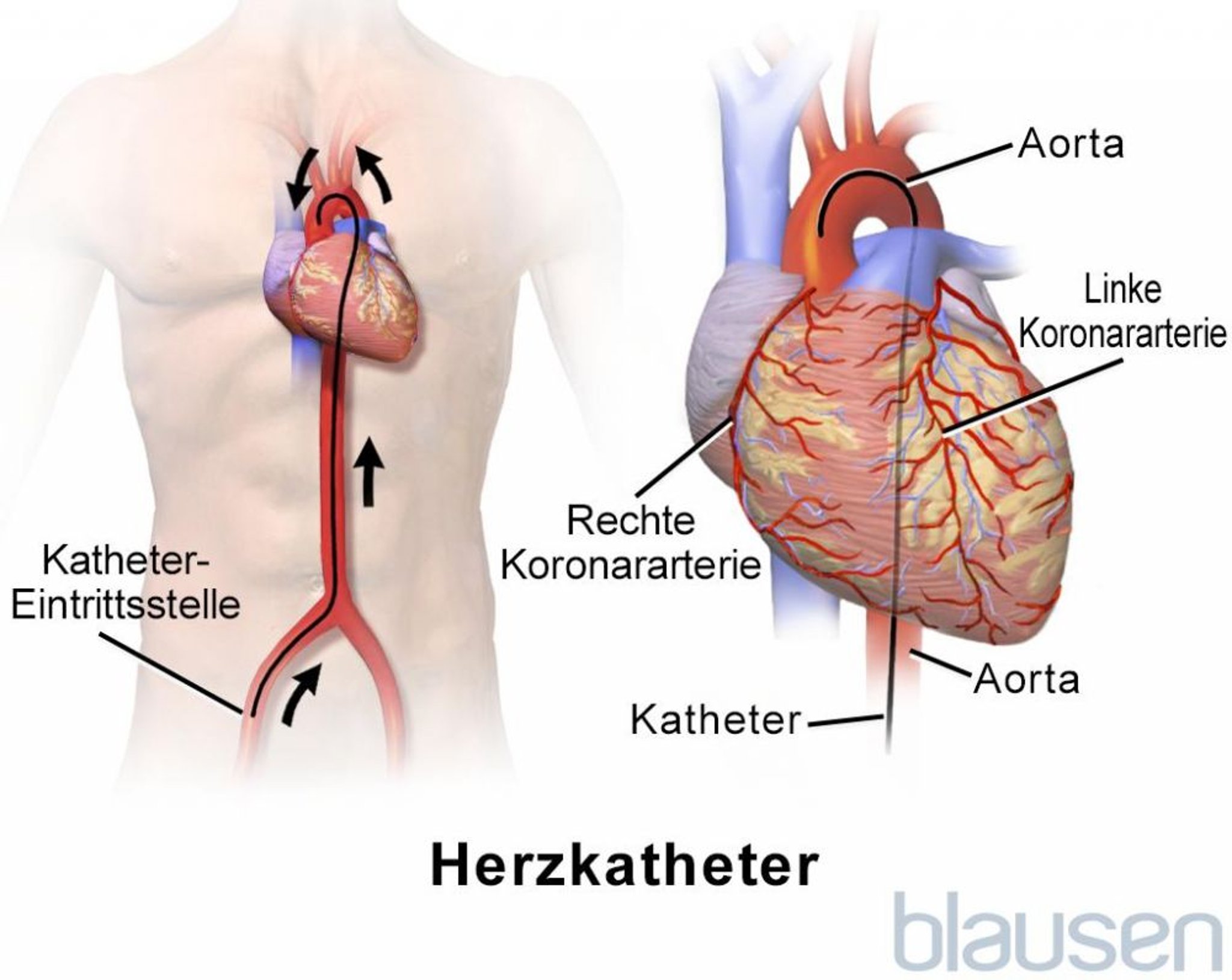 Herzkatheter