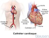 Cathétérisme cardiaque