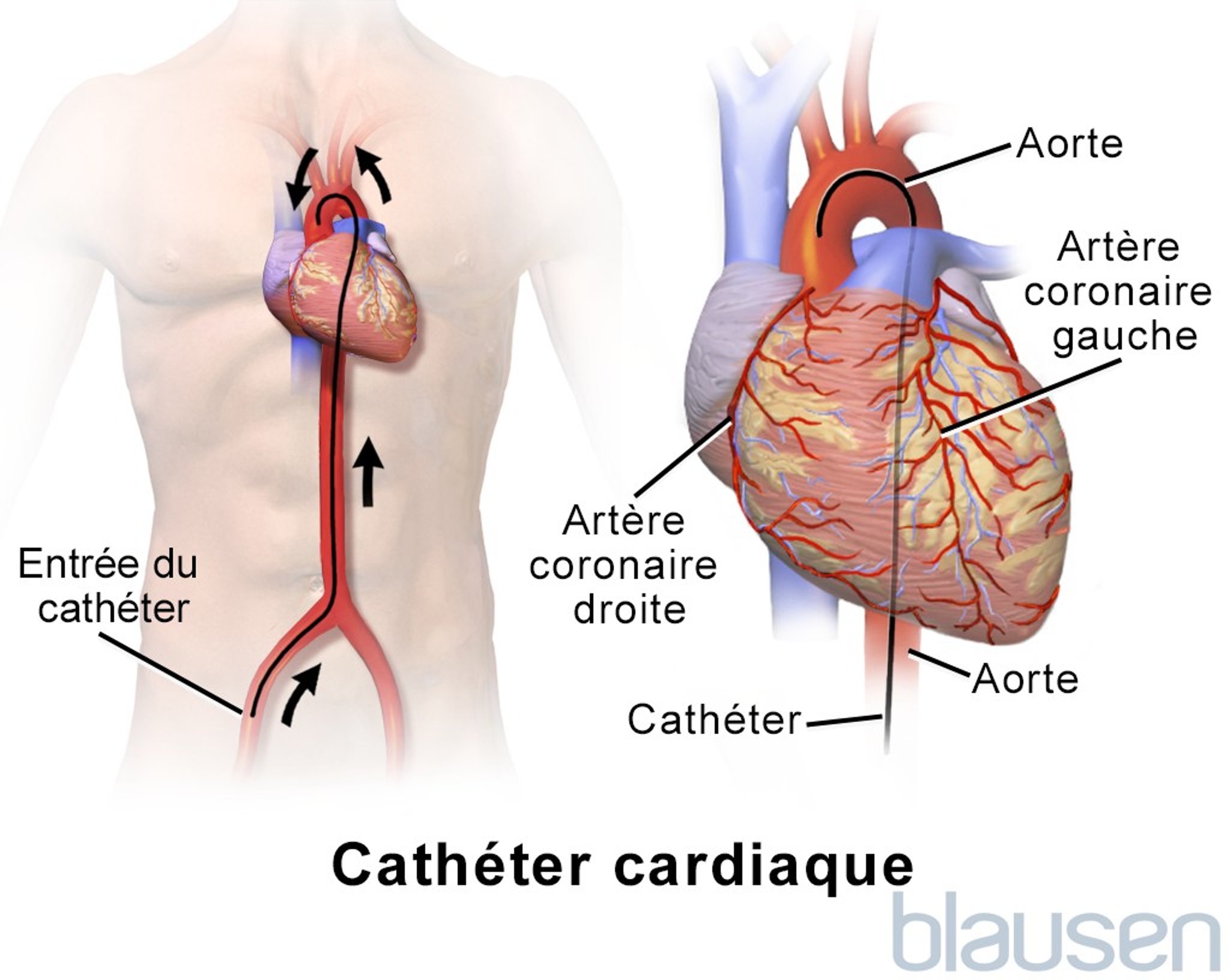 Cathétérisme cardiaque