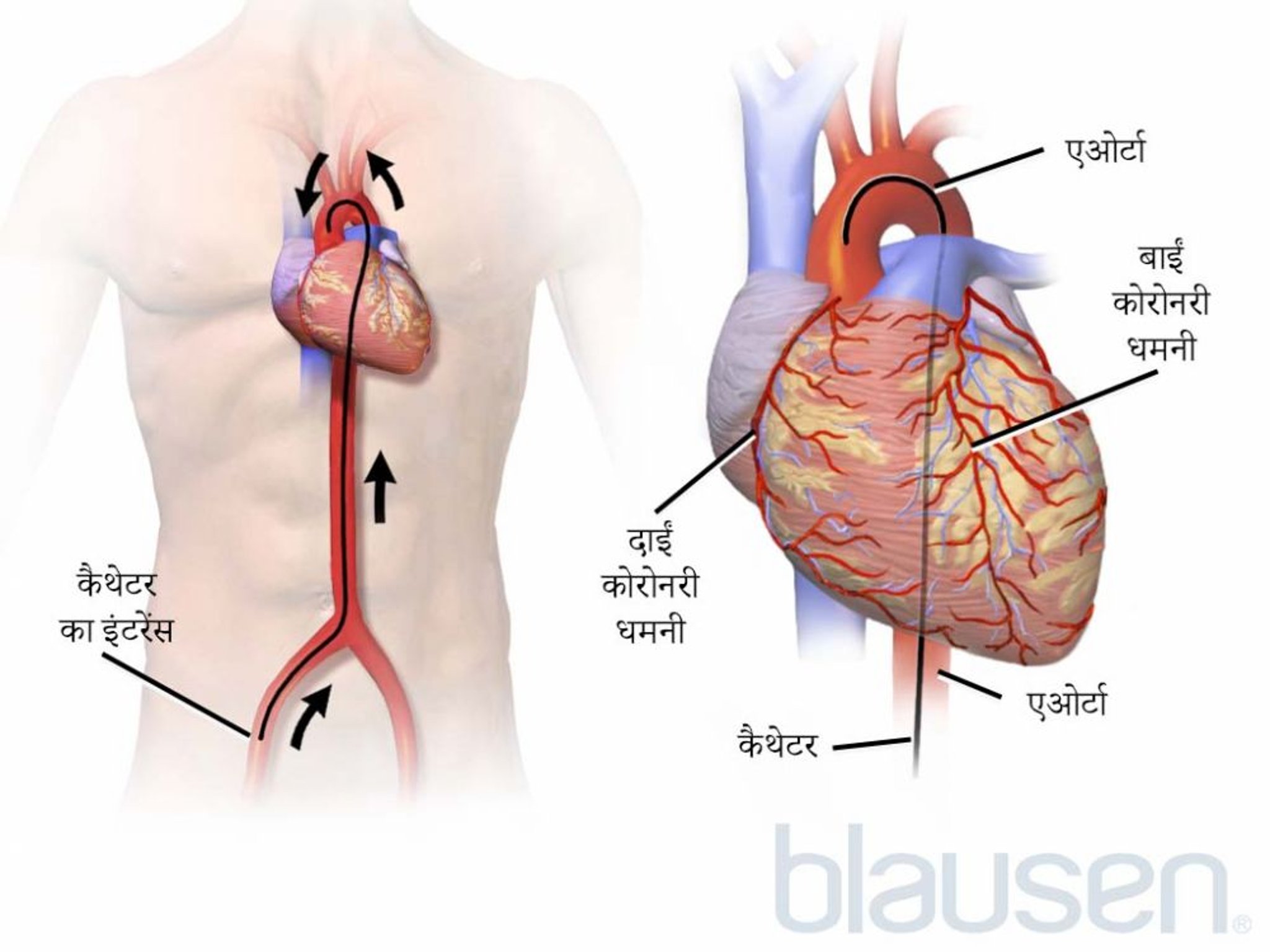 हदय का कैथेटर