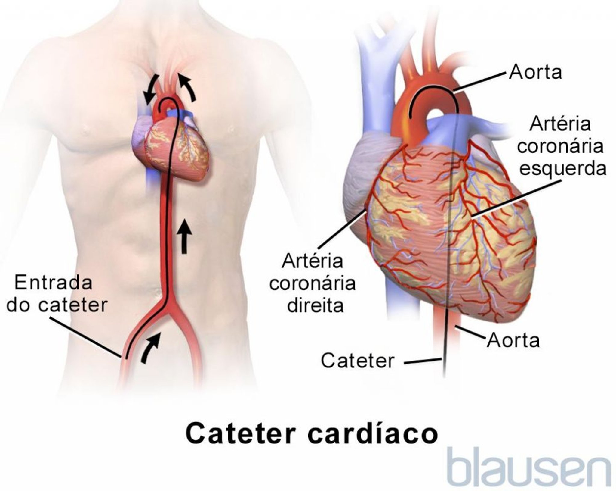 Cateter cardíaco