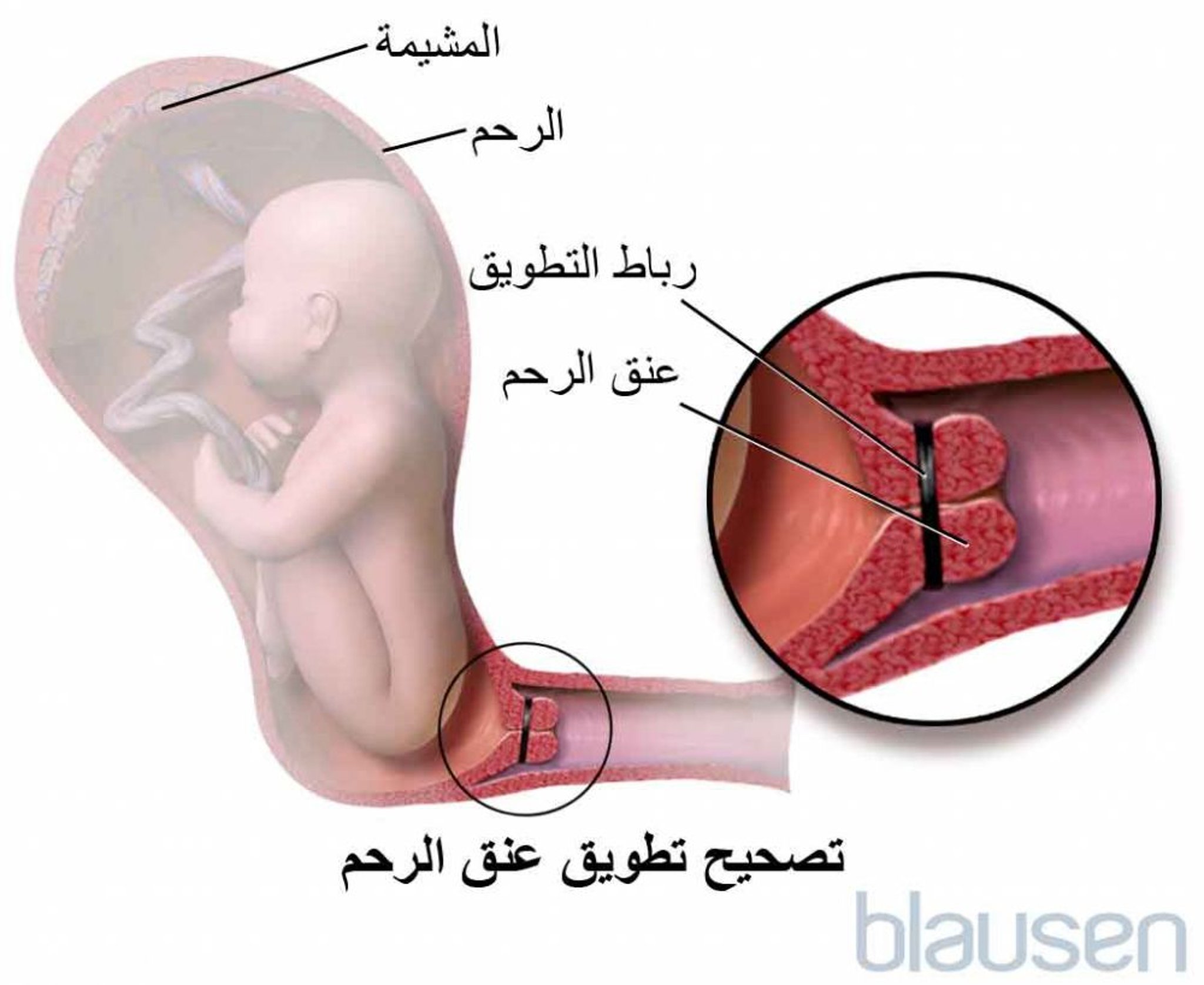 التطويق العنقي