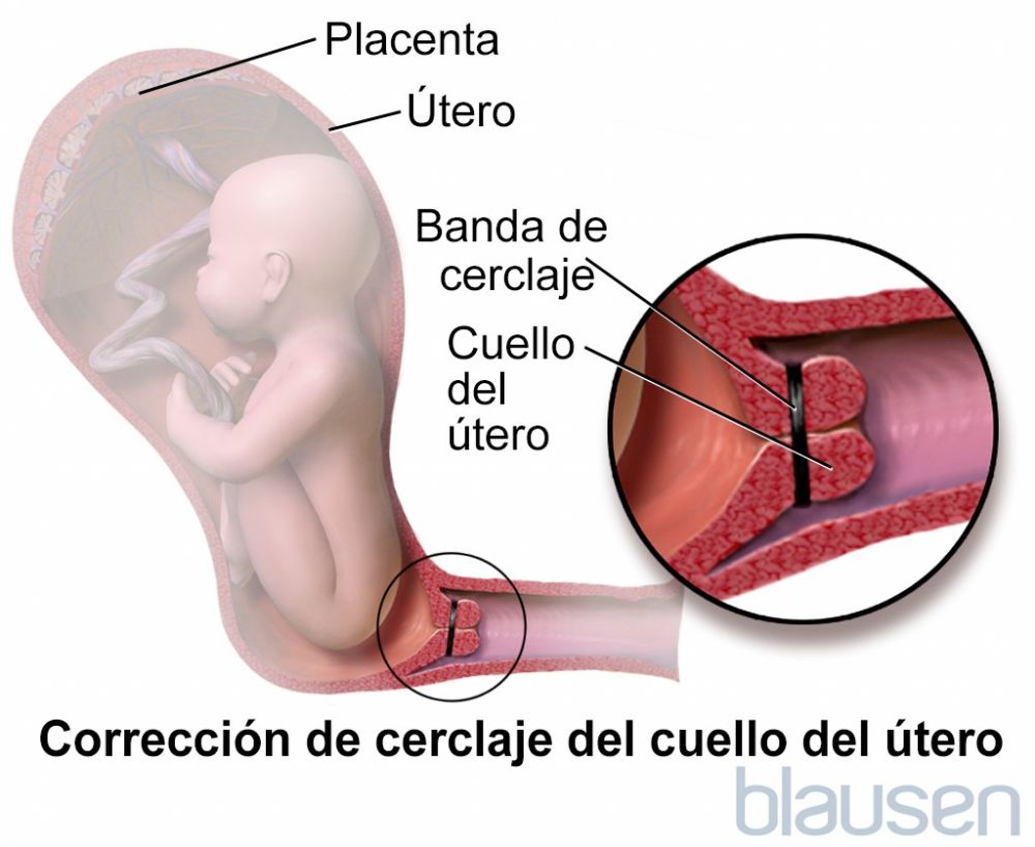 Cerclaje cervical
