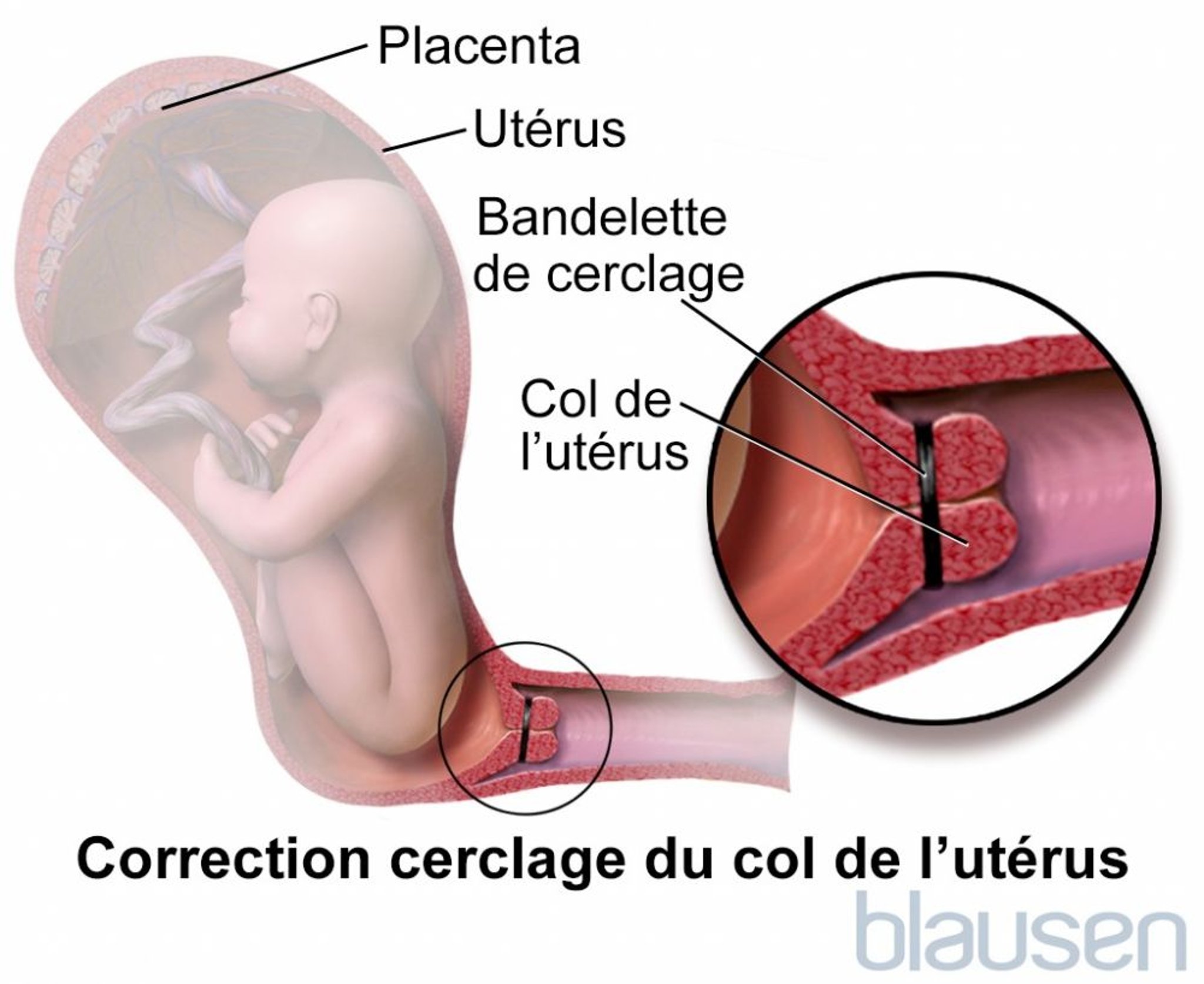 Cerclage du col de l’utérus