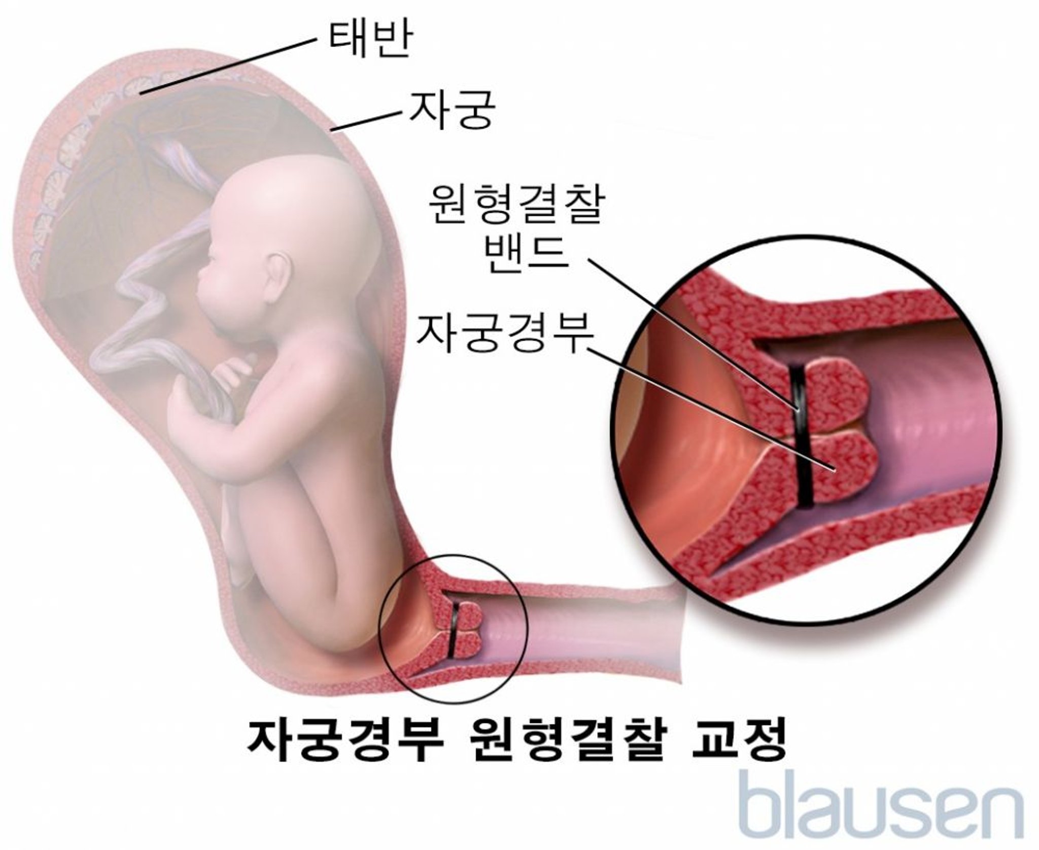 자궁경부 결찰