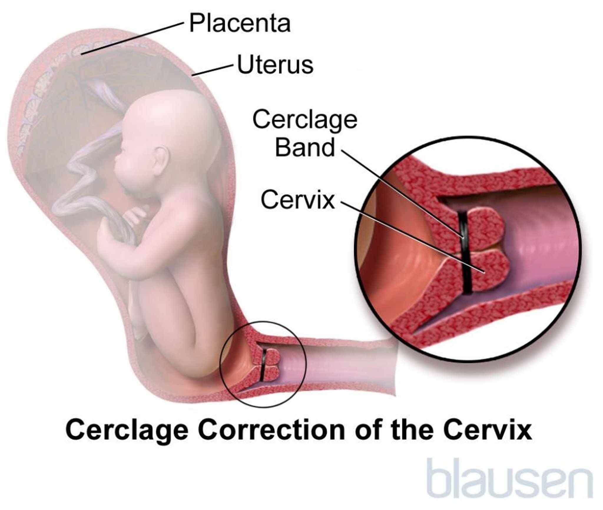 Cerclagem cervical