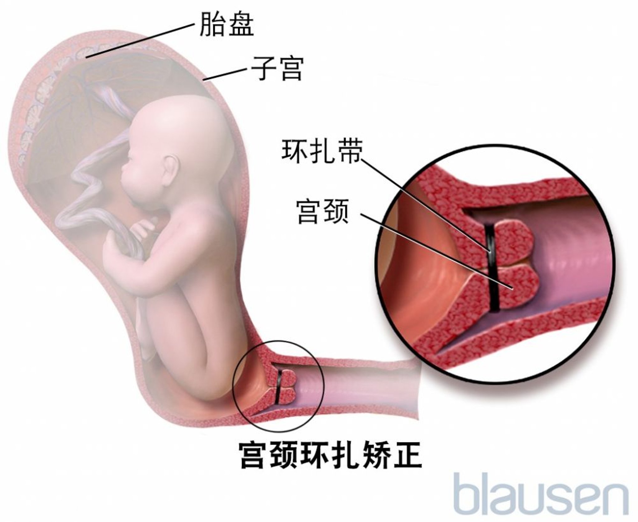 宫颈环扎术