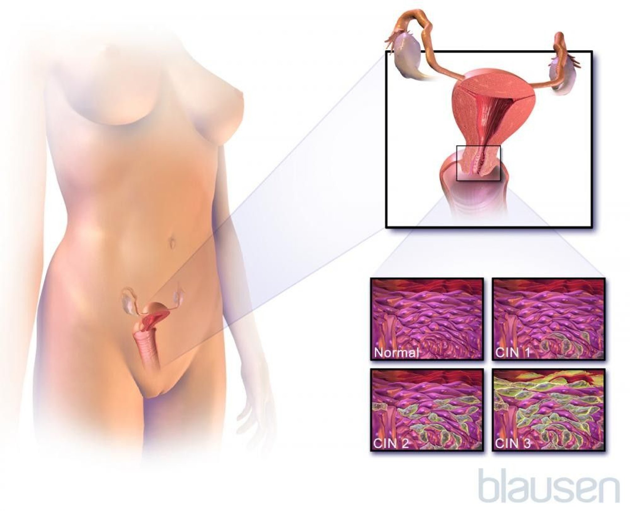 Cervical Dysplasia