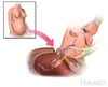 Cesarean Delivery