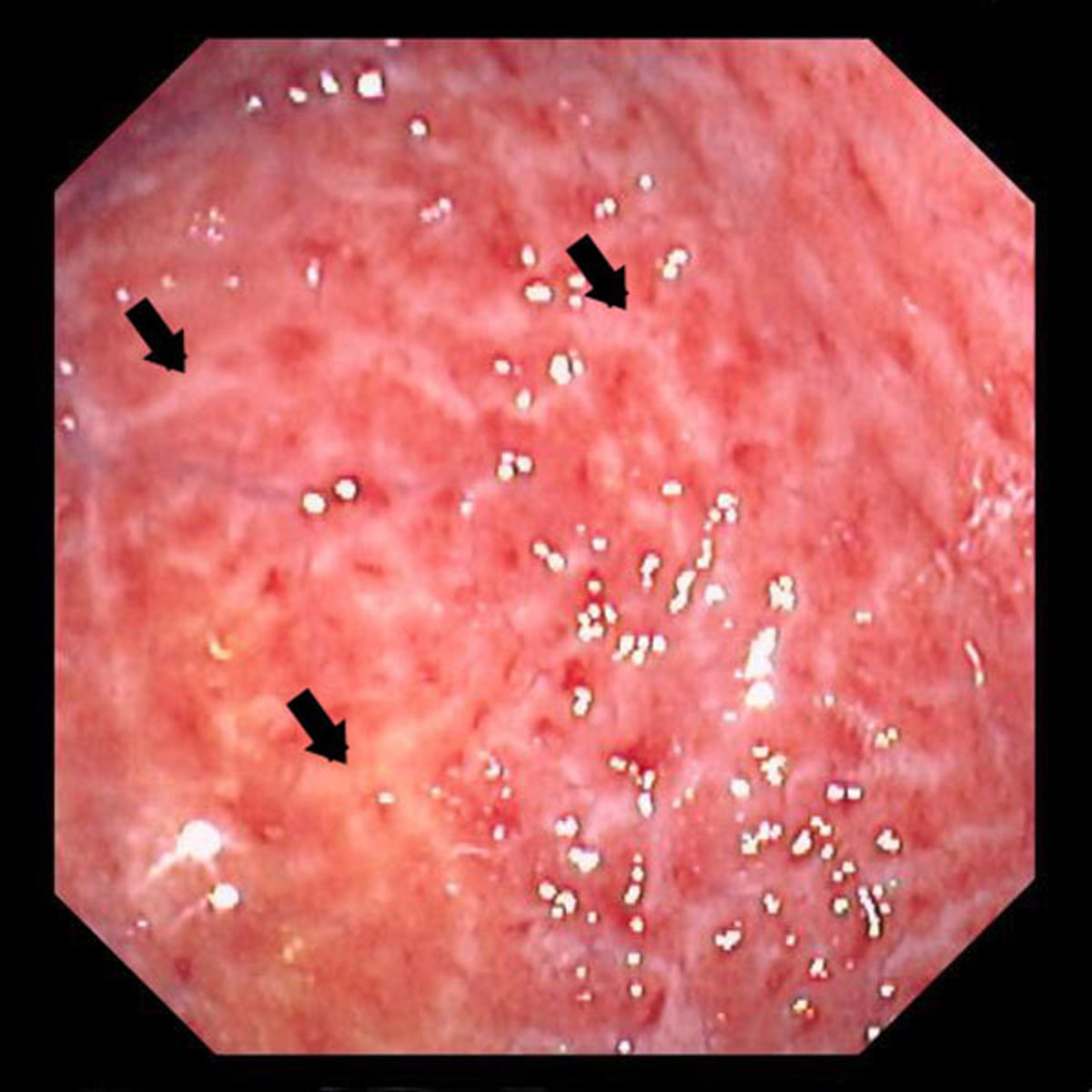 Chronic Gastritis