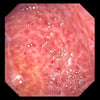 Chronische Gastritis