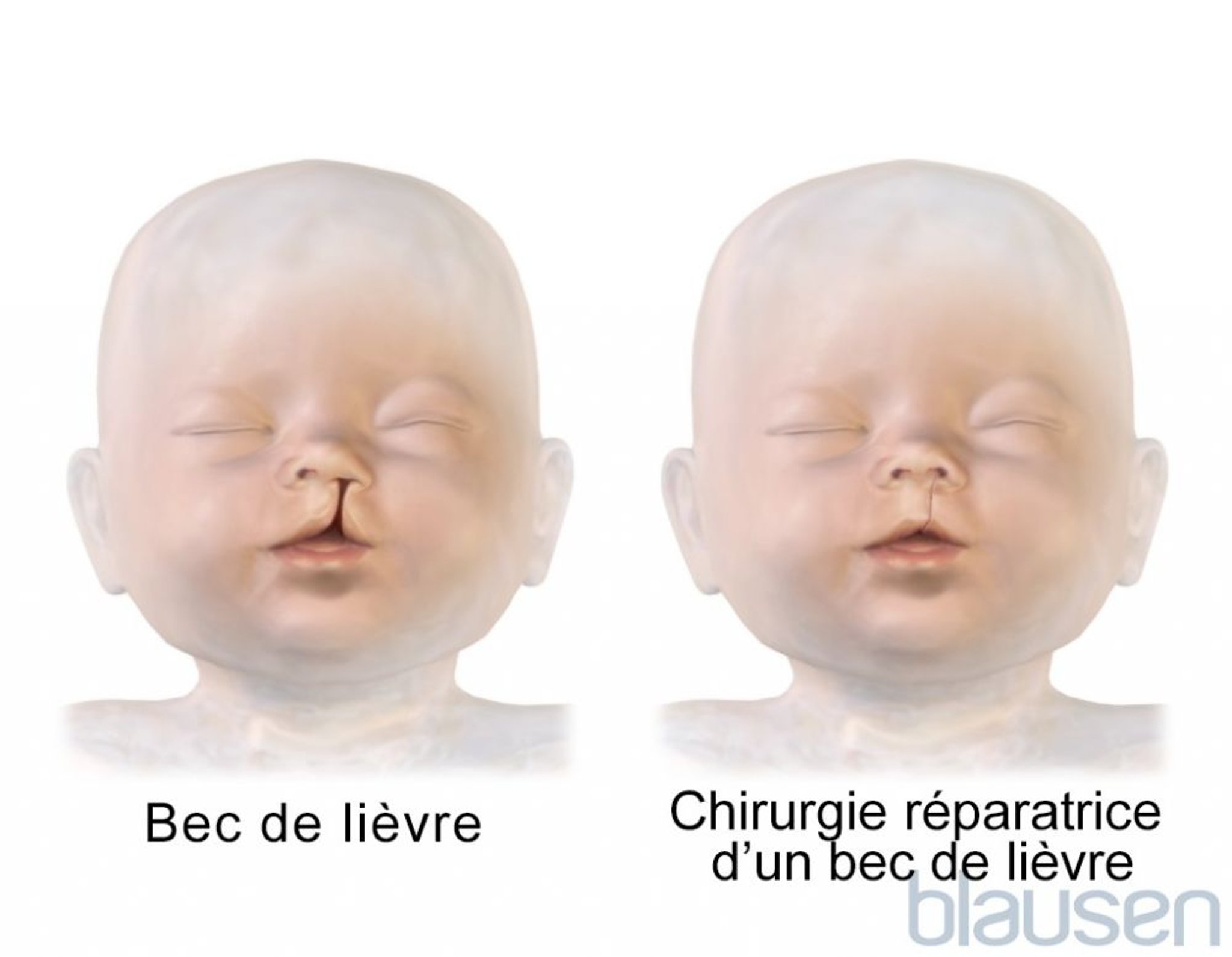 Réparation du bec-de-lièvre