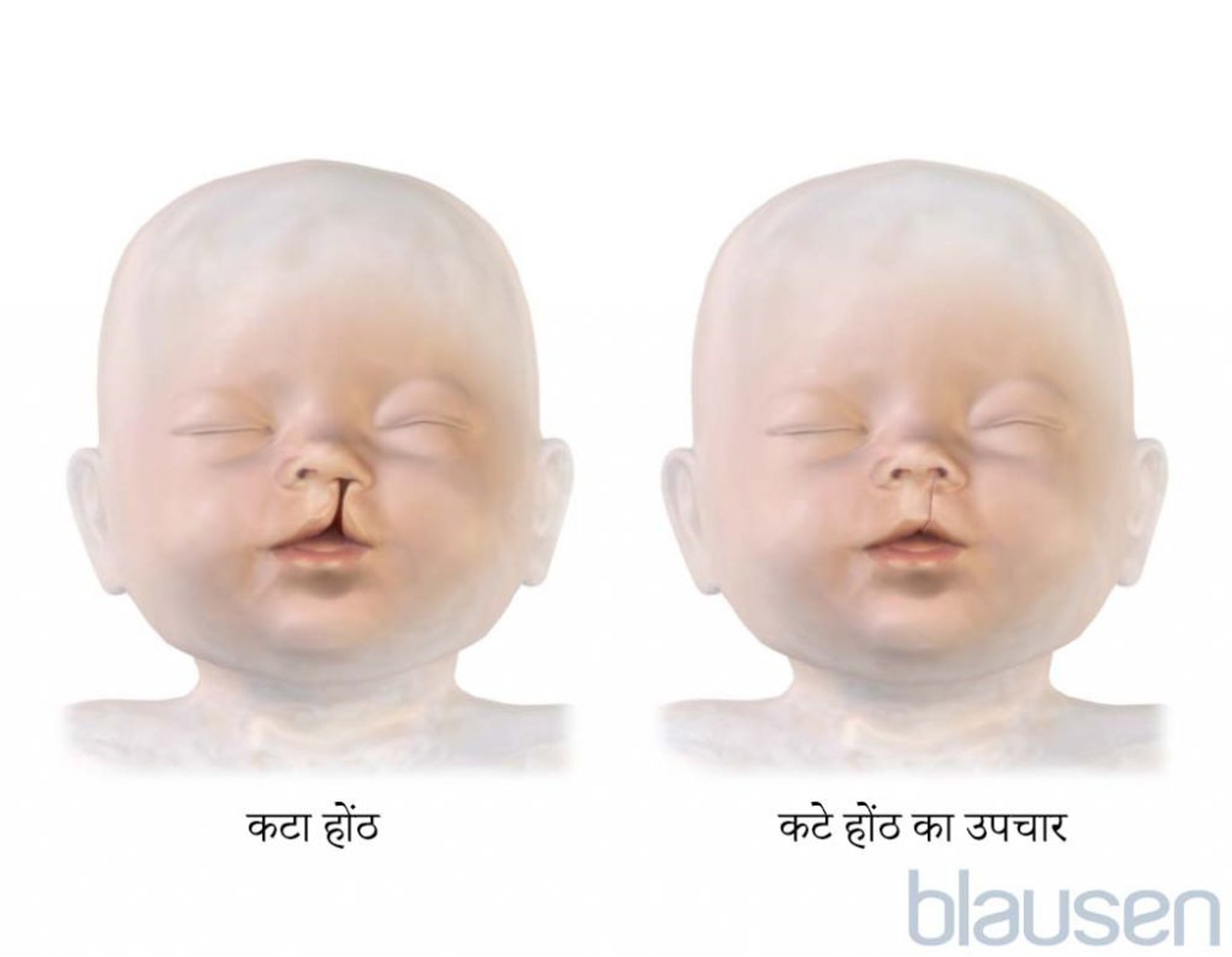 कटे होंठ का उपचार