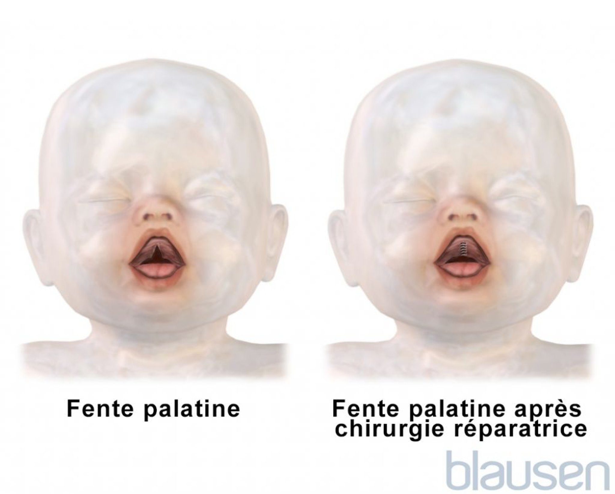 Réparation de fente palatine