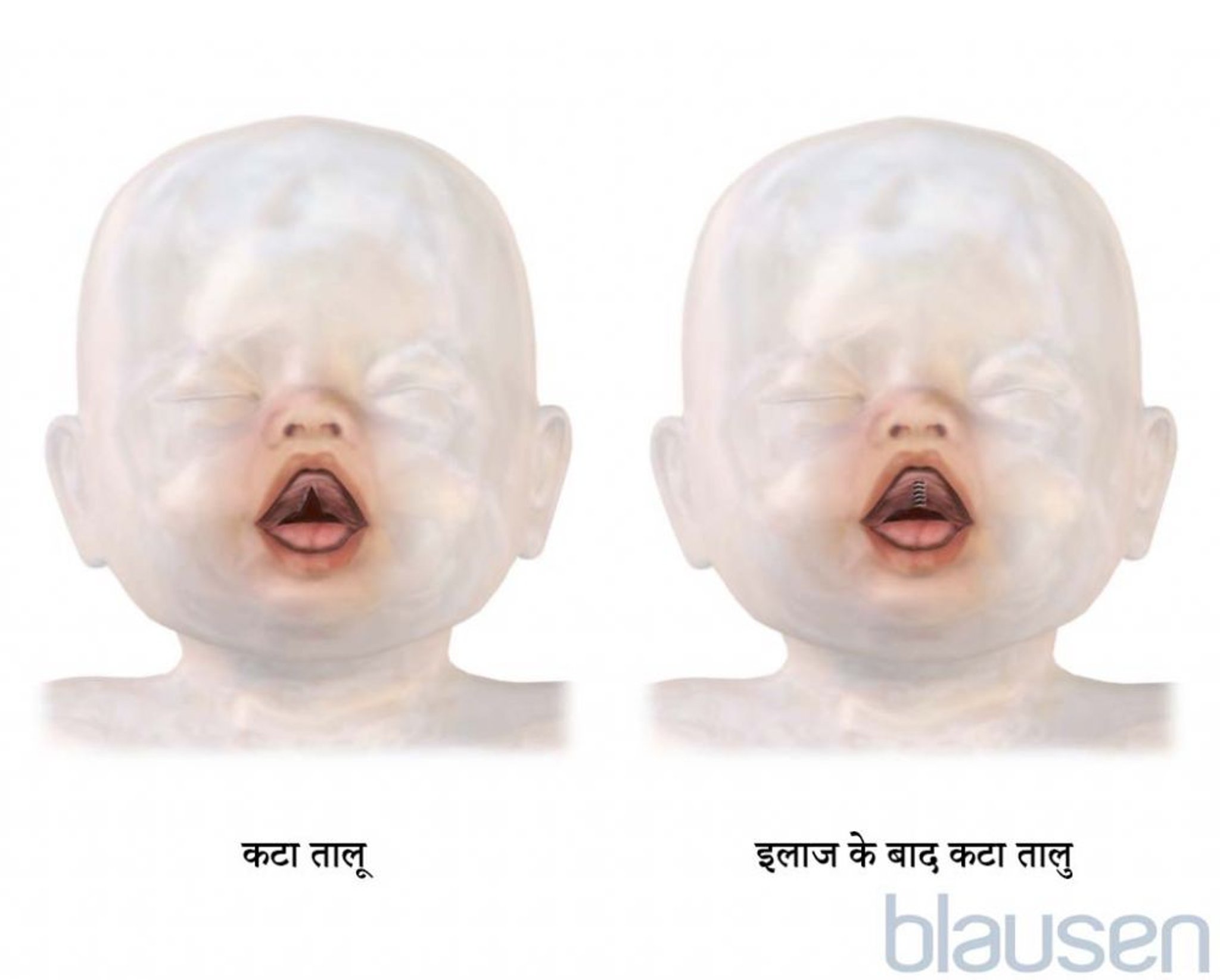 कटे तालु का उपचार