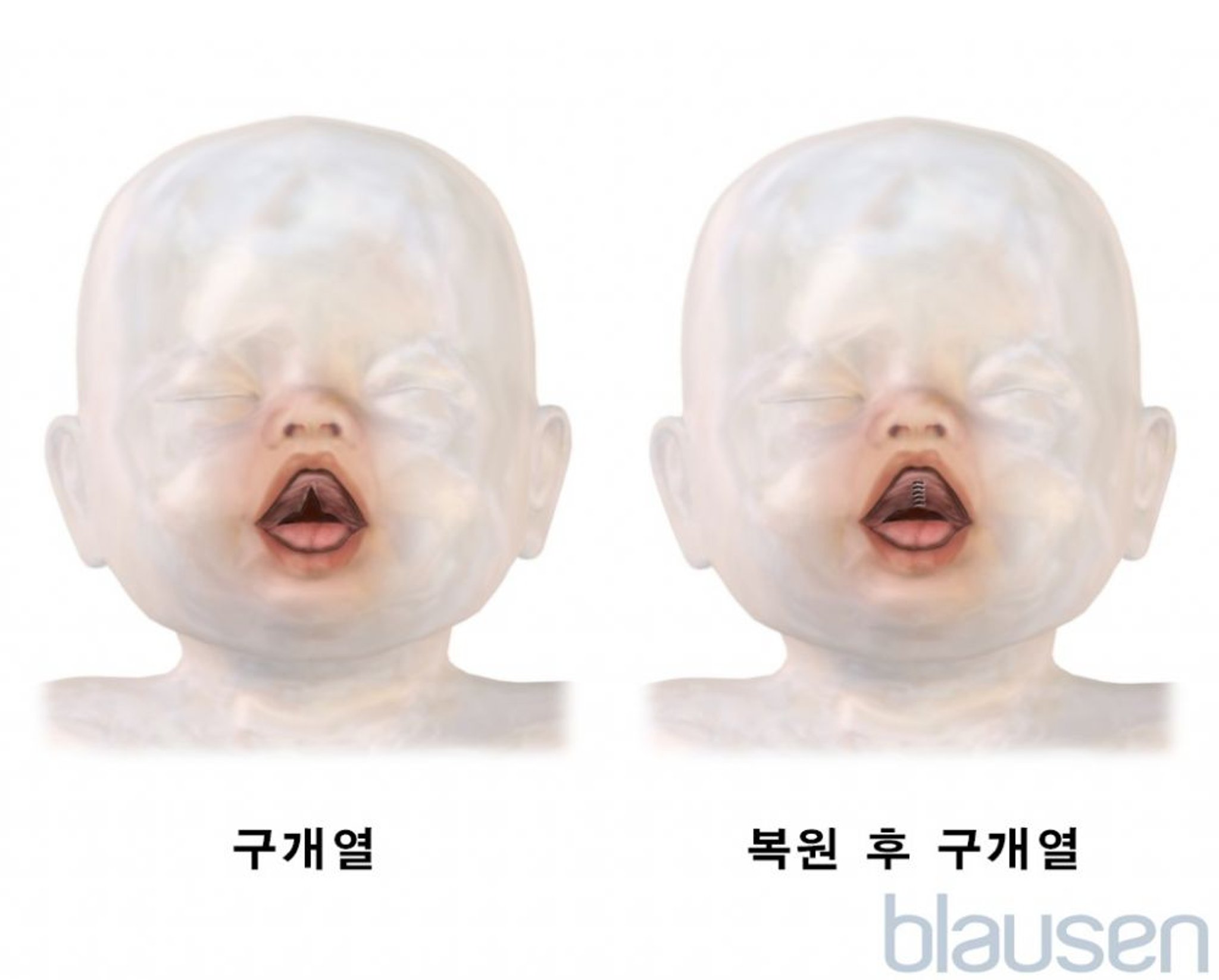 구개 파열 복원