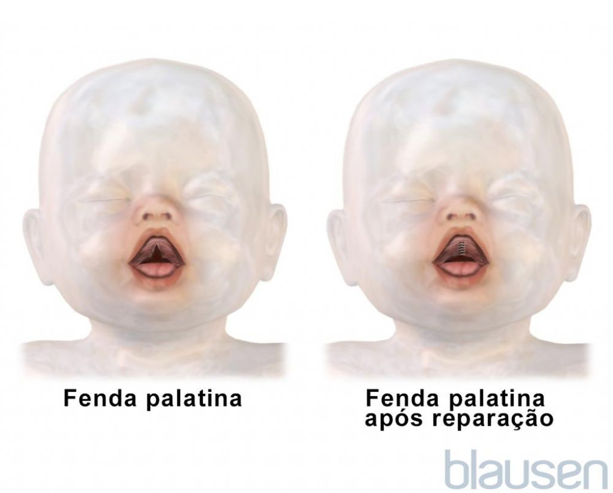 Reparo de fenda palatina