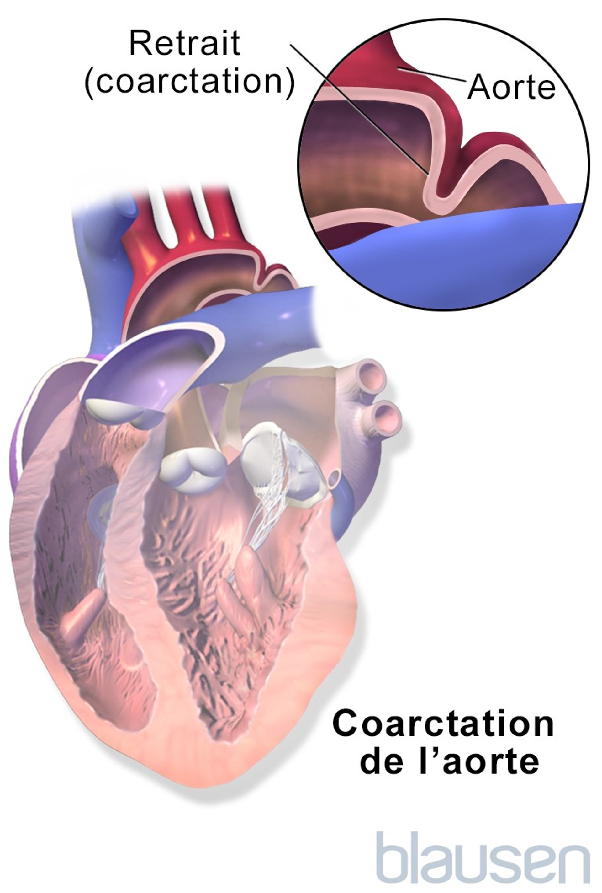 Coarctation de l’aorte