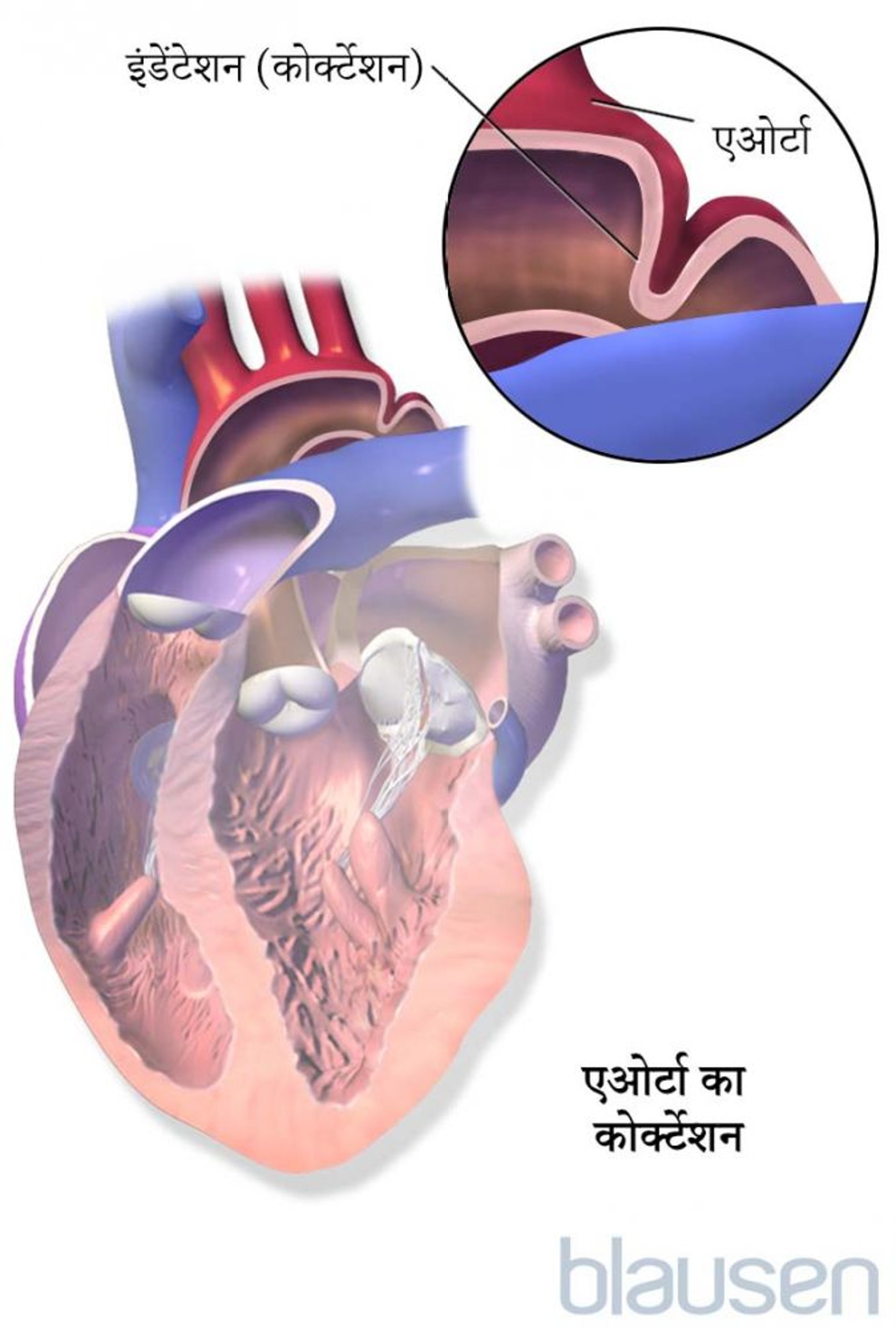 एओर्टा में कोर्क्टेशन