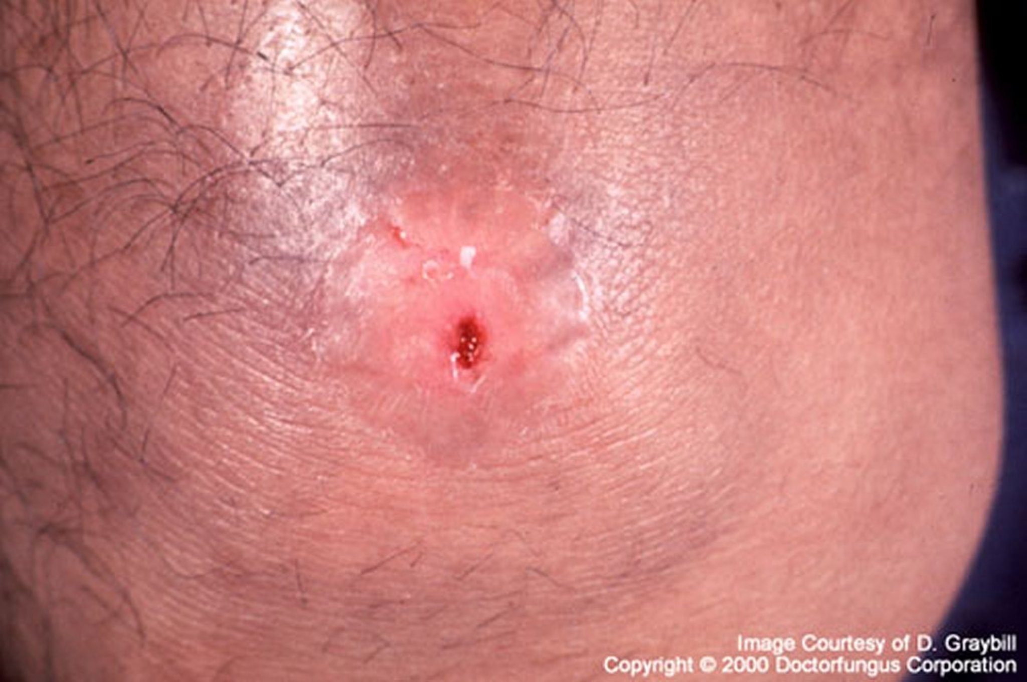 Coccidioidomycosis Causing a Single Sore