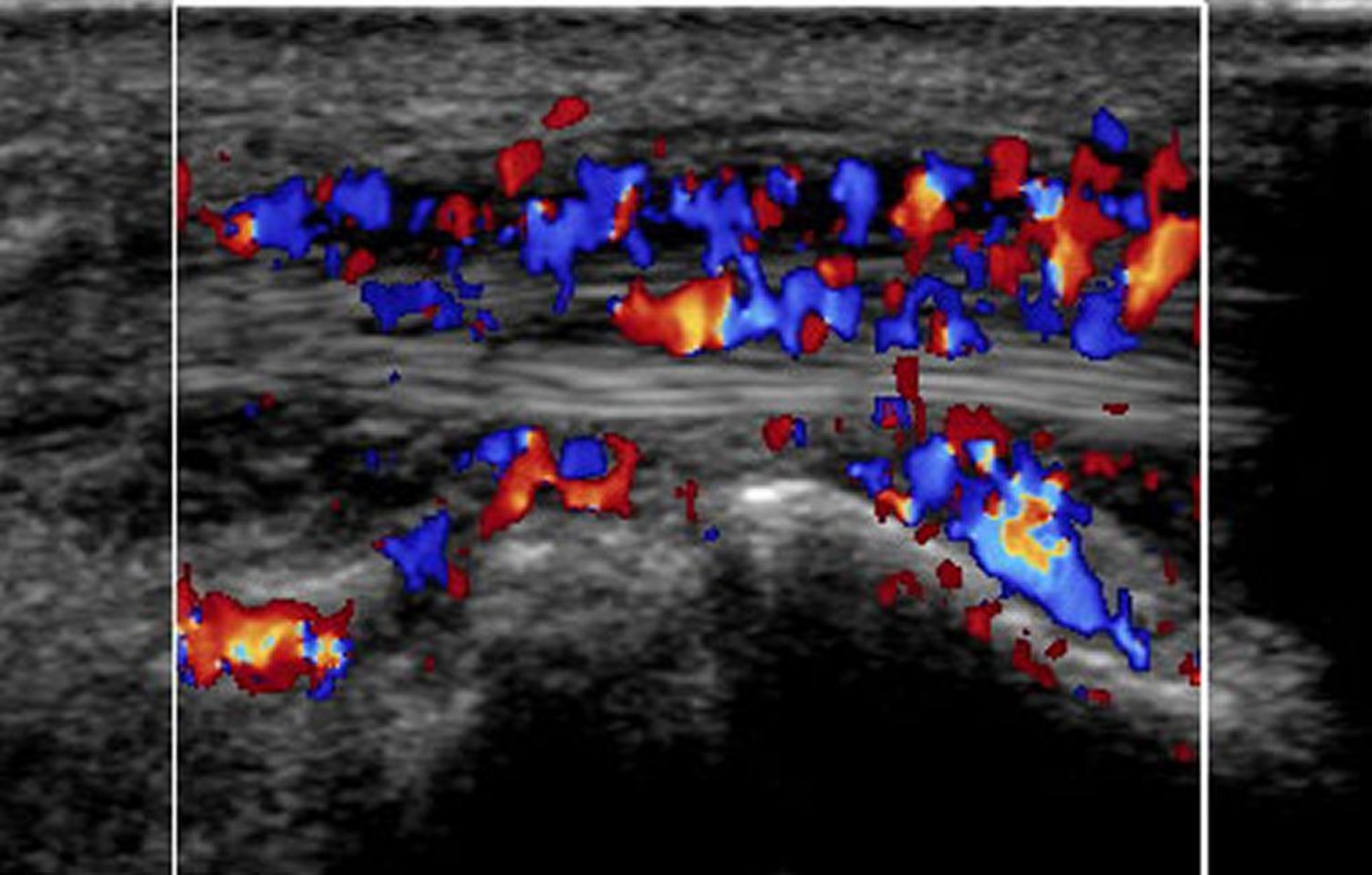 Ultrassonografia Doppler em cores da artéria carótida