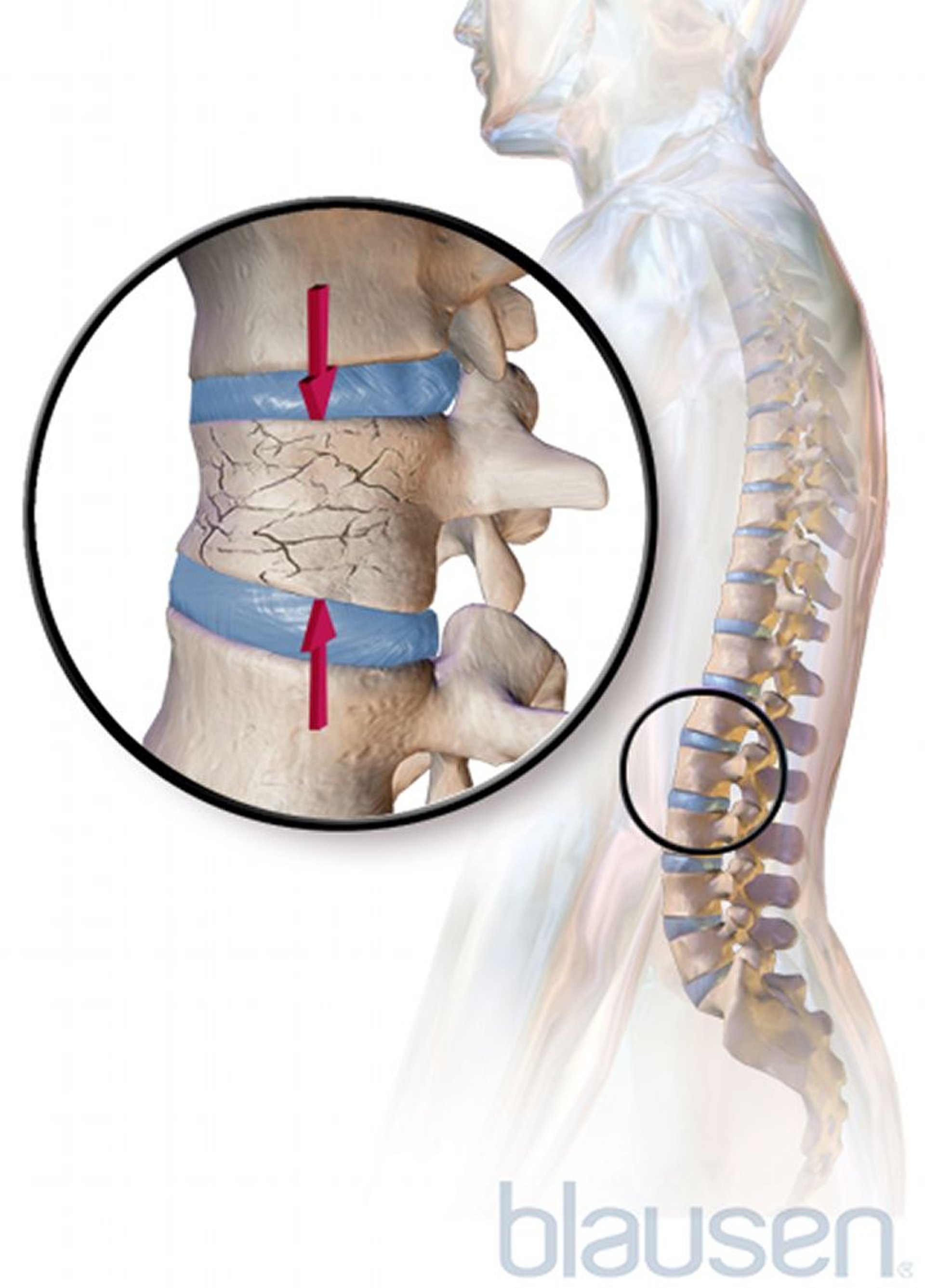 Fratura de compressão da coluna vertebral devido à osteoporose