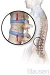 Fracture par compression de la moelle épinière