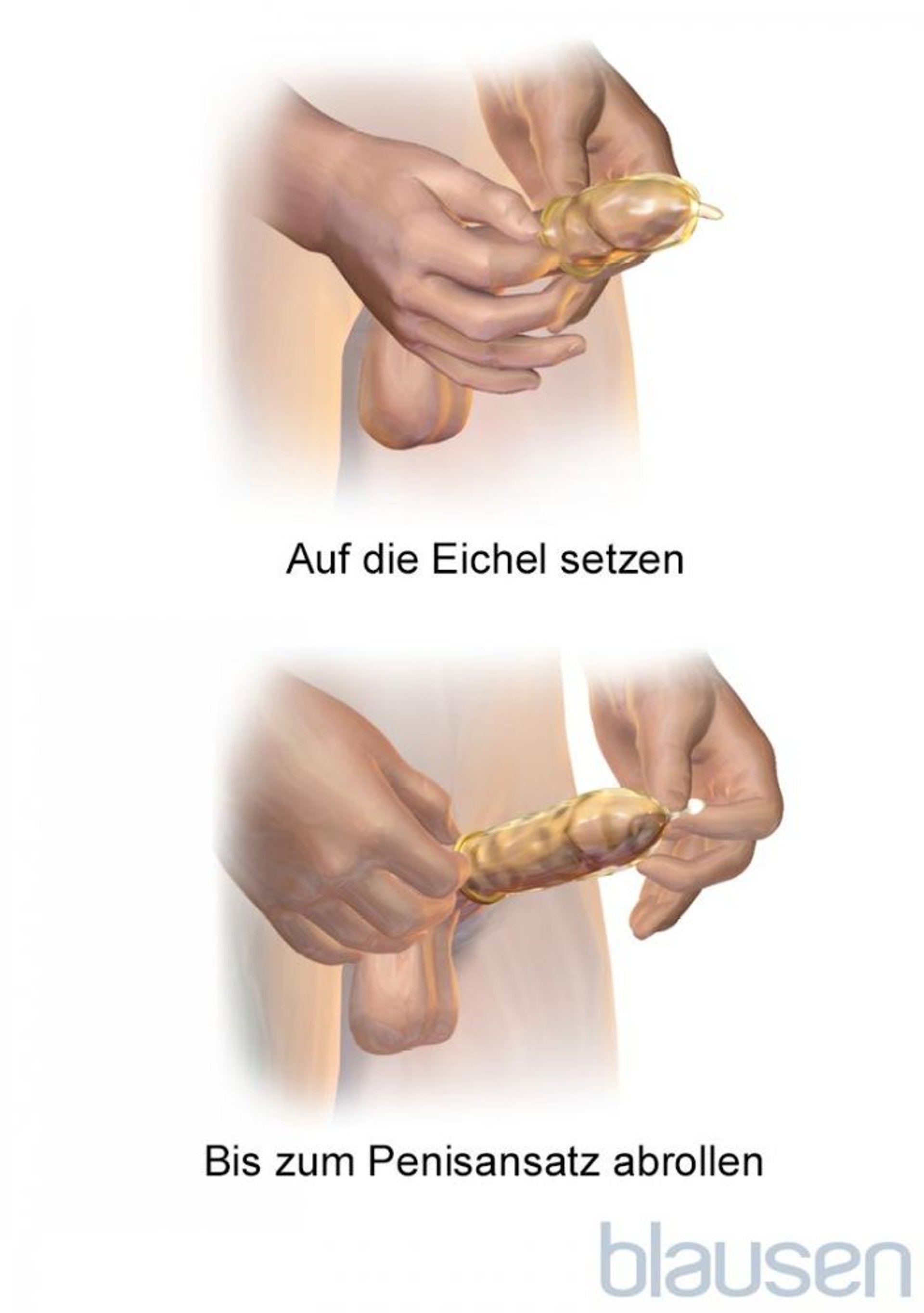 Anlegen eines Kondoms beim Mann