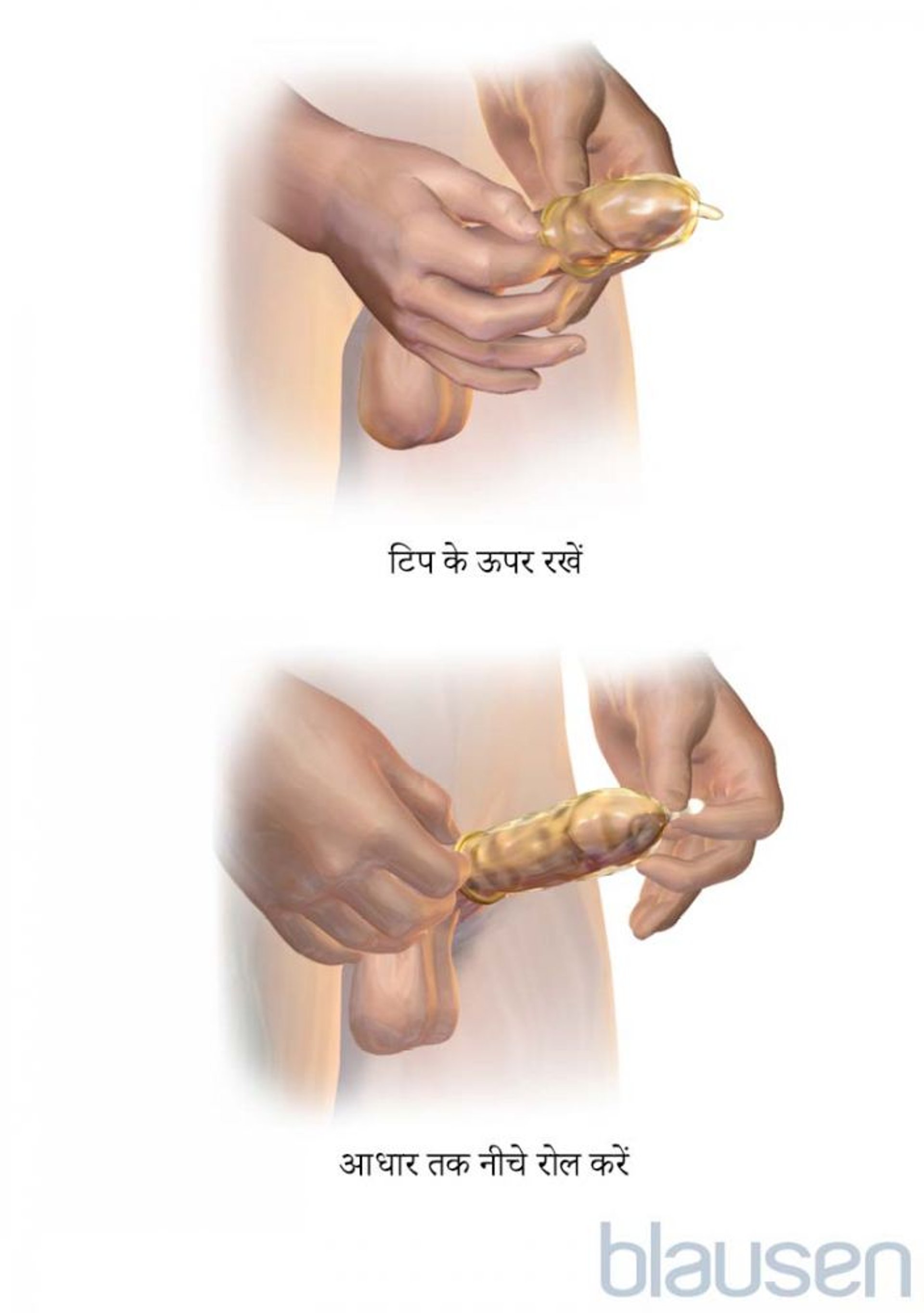 बाहरी कंडोम कैसे लगाएं