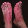 Allergic Contact Dermatitis (3)