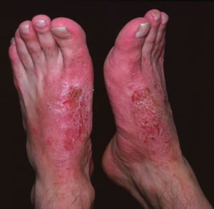 Allergic Contact Dermatitis (3)