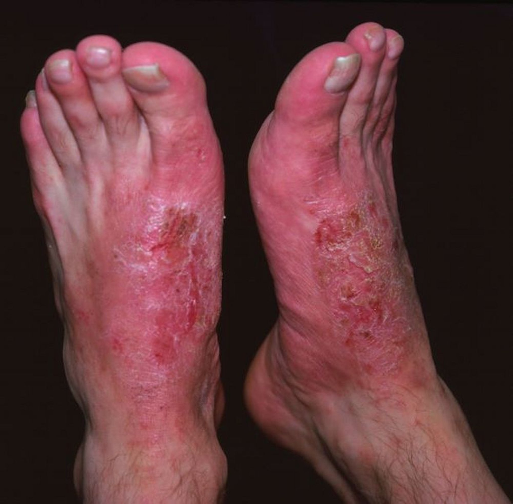 Kontaktdermatitis (Füße)